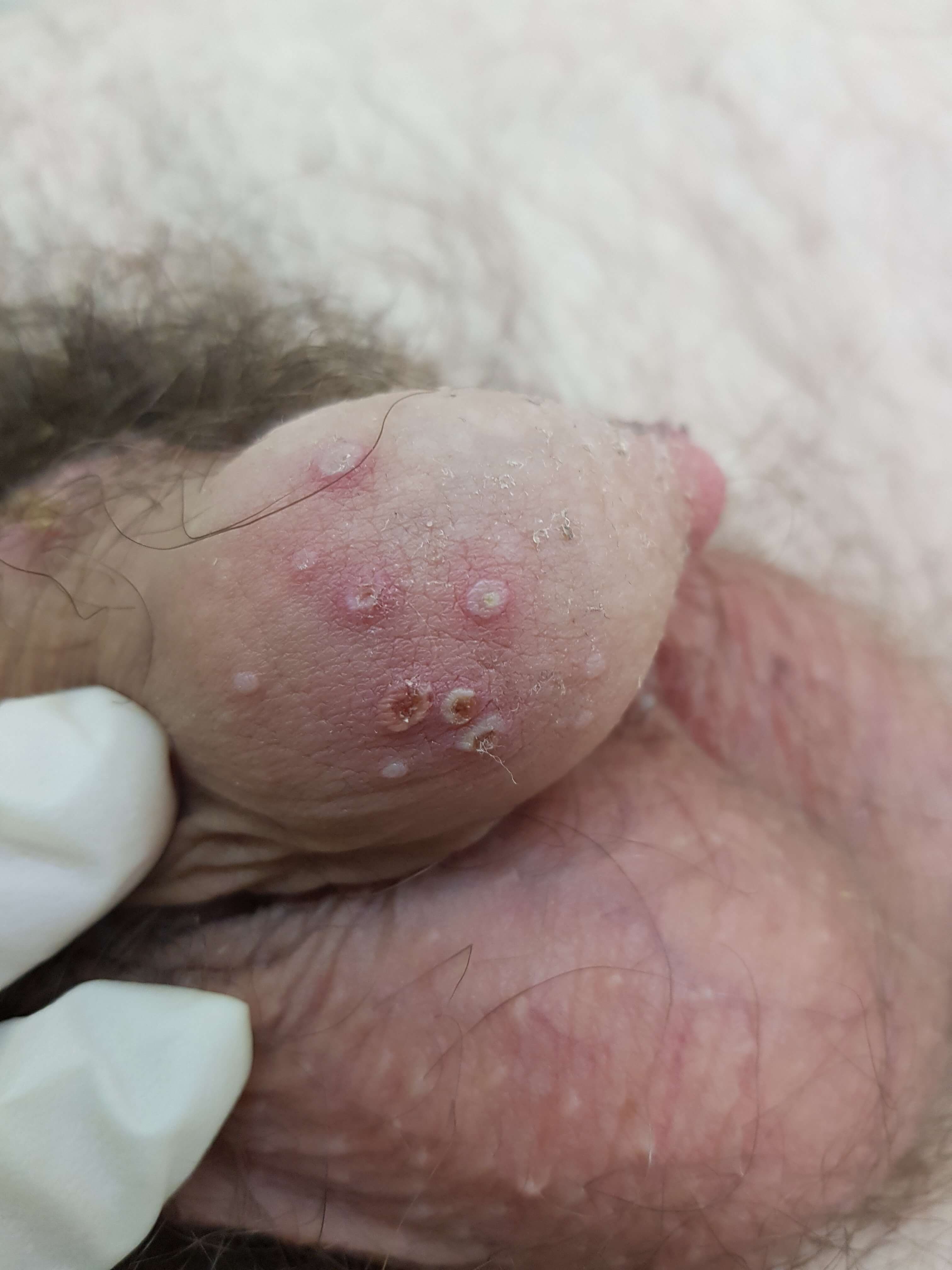 герпес на половом члене