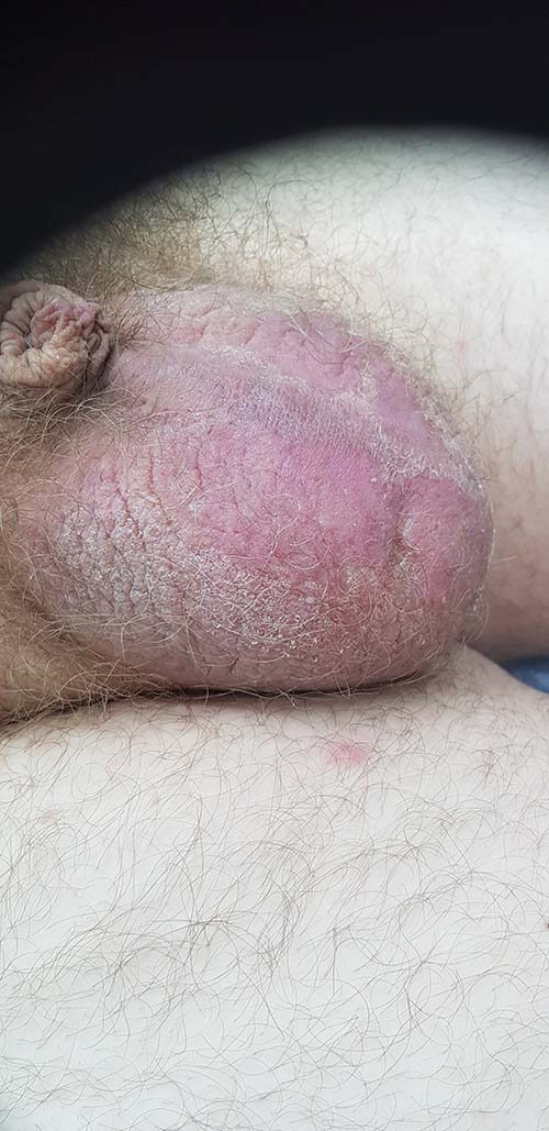 повышение температуры высокая температура