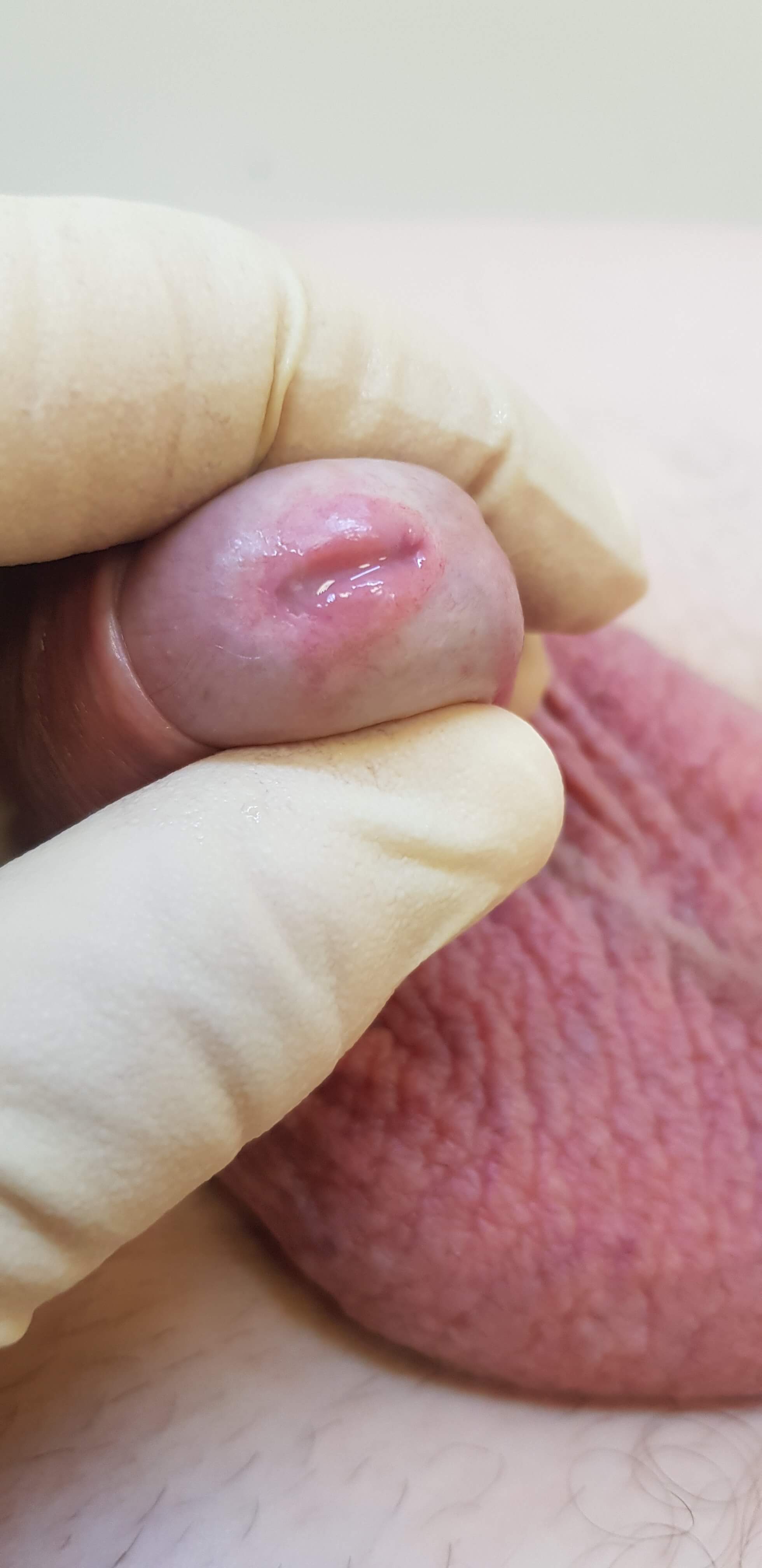 трихомонада