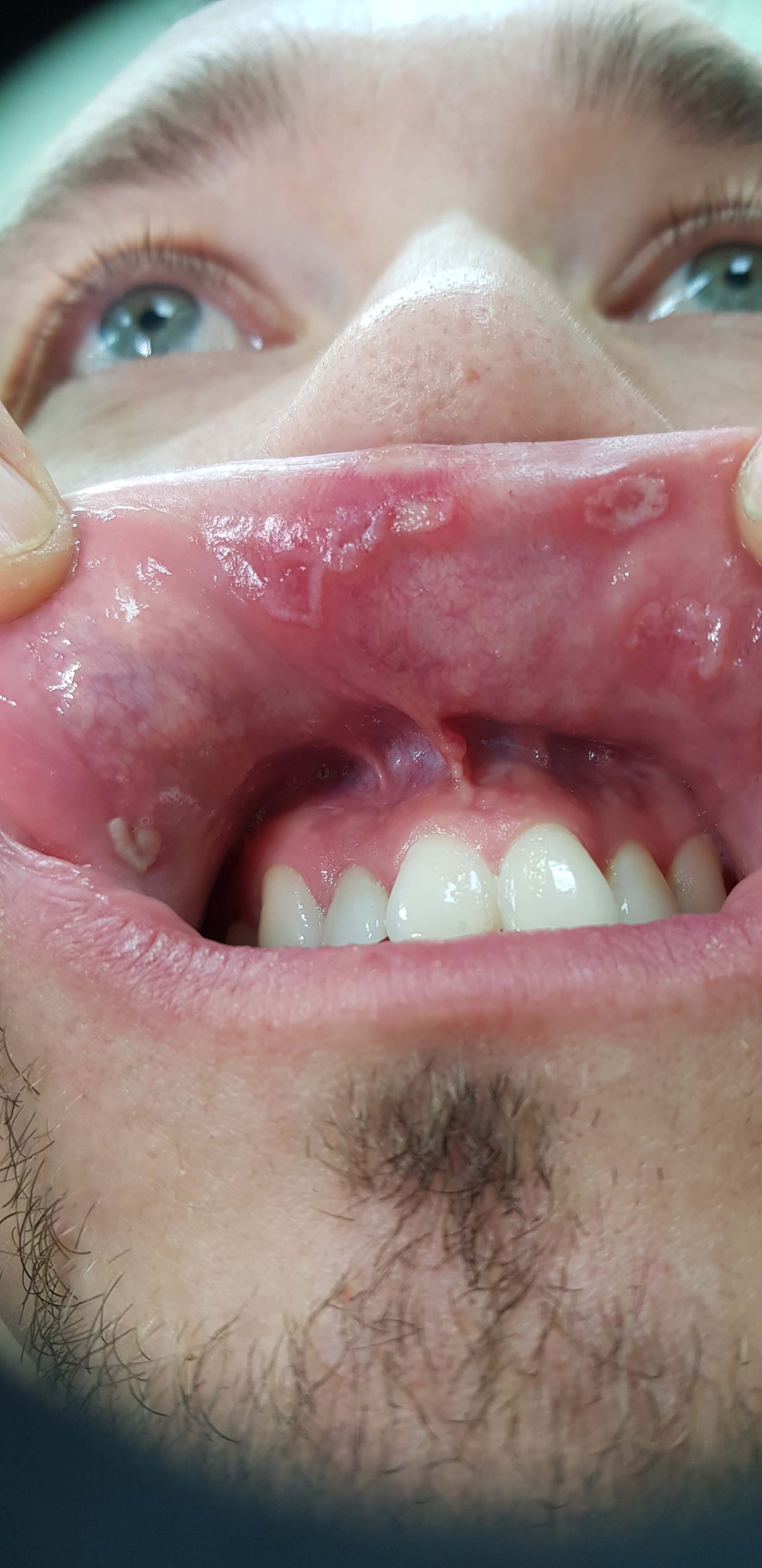 шанкр на языке