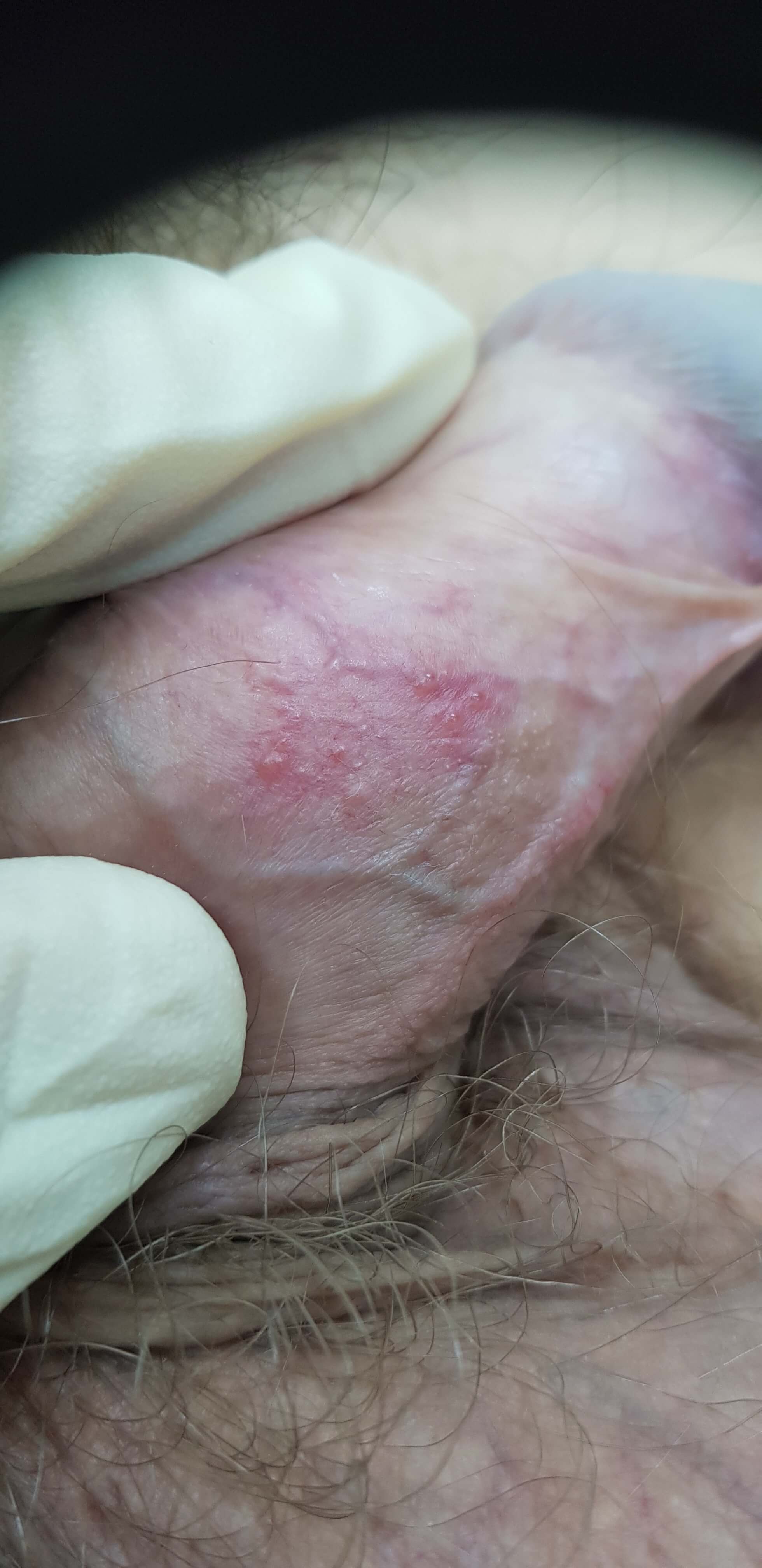 Генитальный герпес