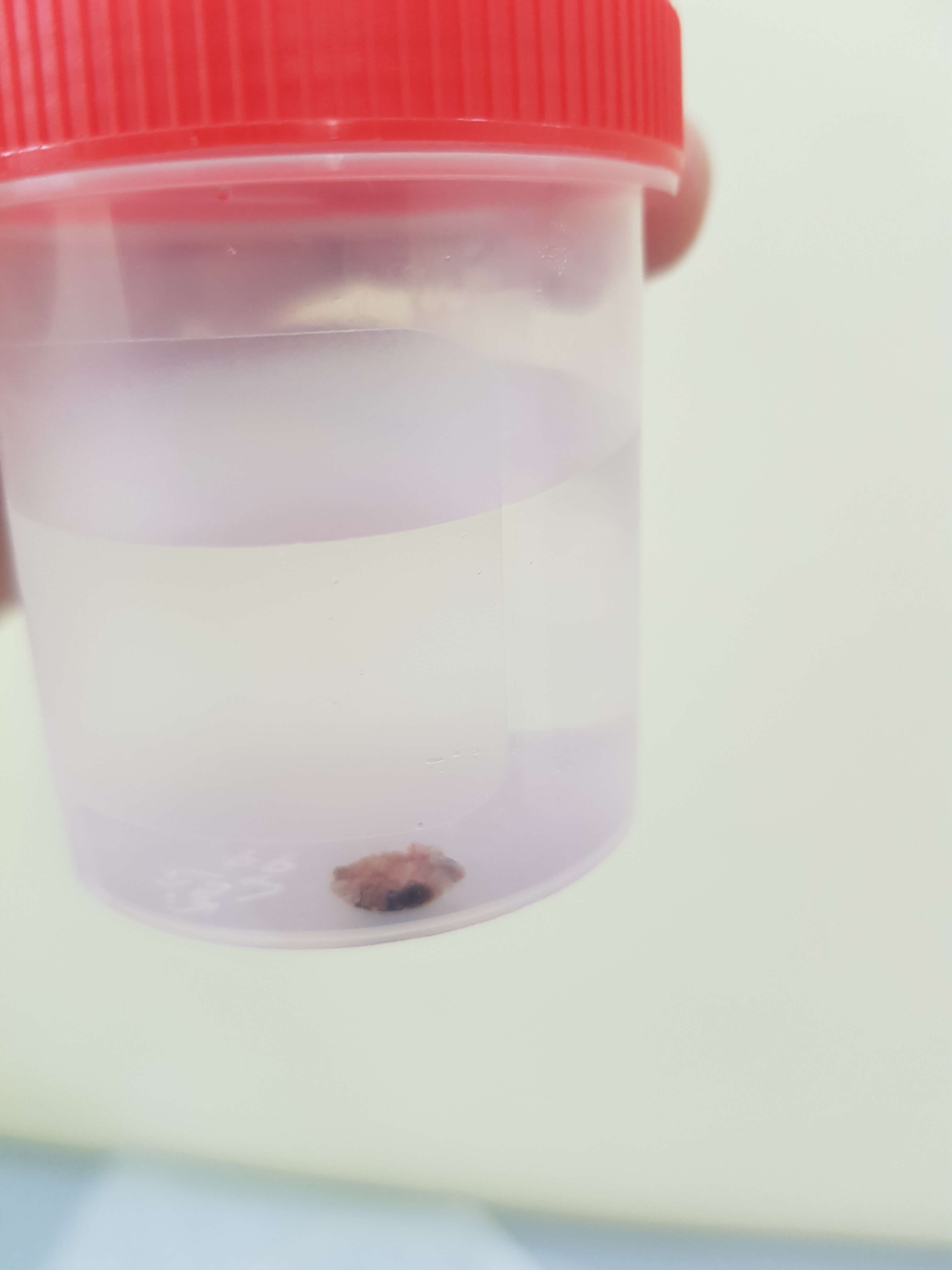 удаление новообразований гистология родинки