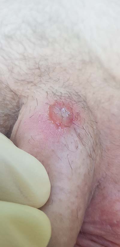 анализ крови на сифилис