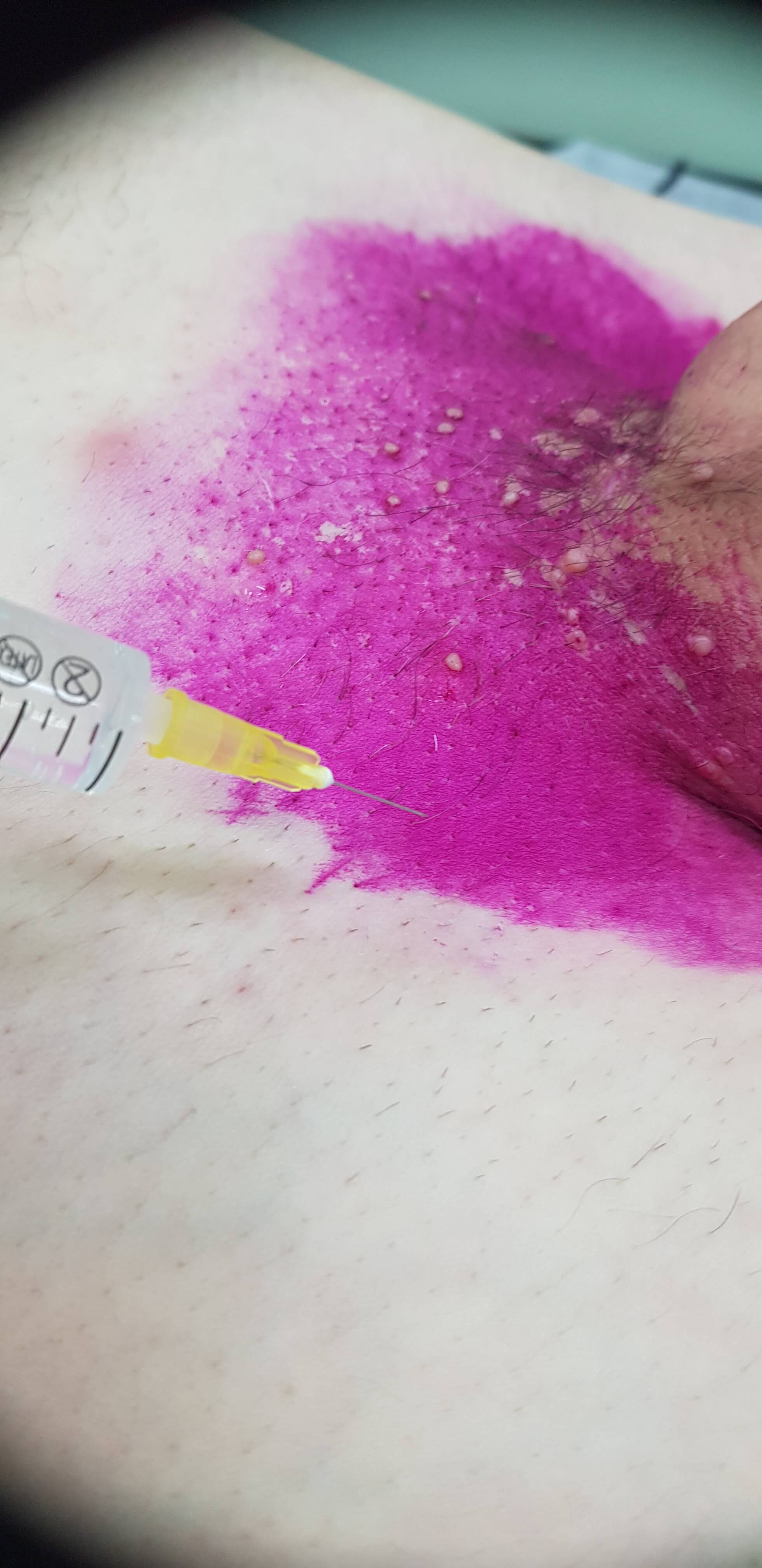 лимфотропное введение антибиотиков