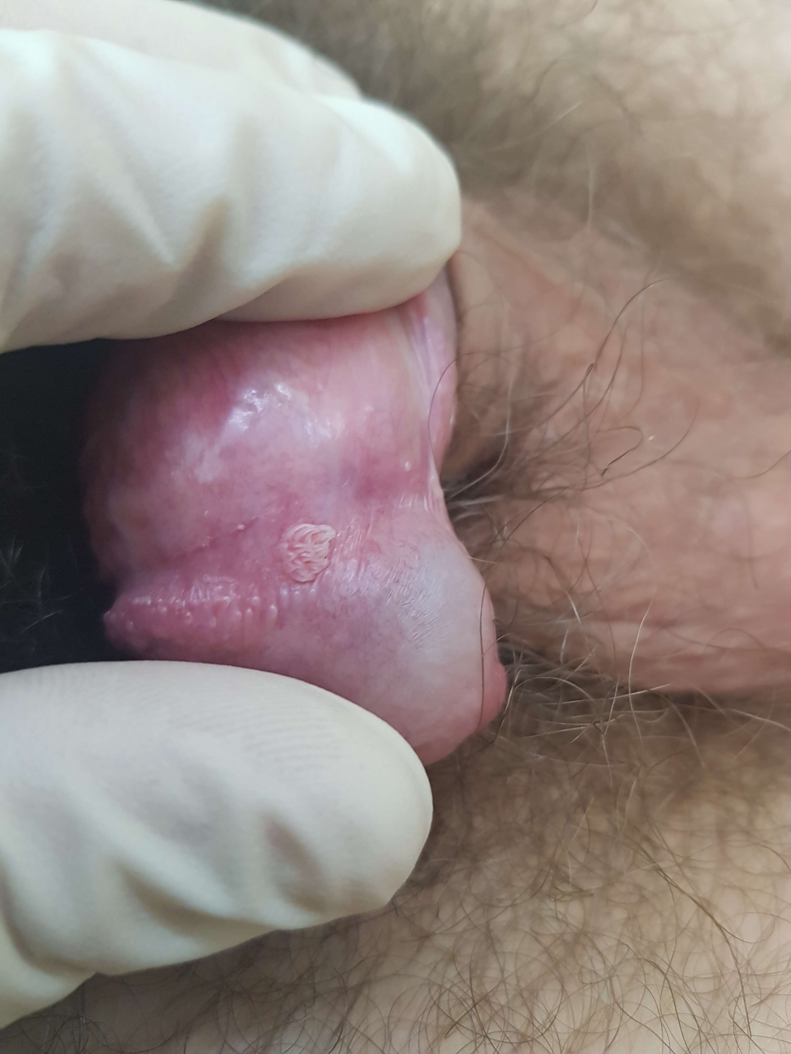 ВПЧ кондилома в венечной борозде