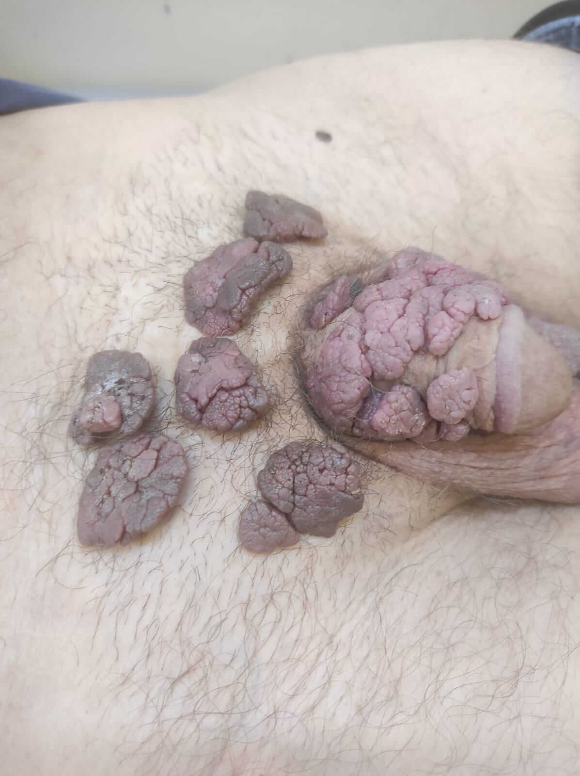 Папилломы на члене