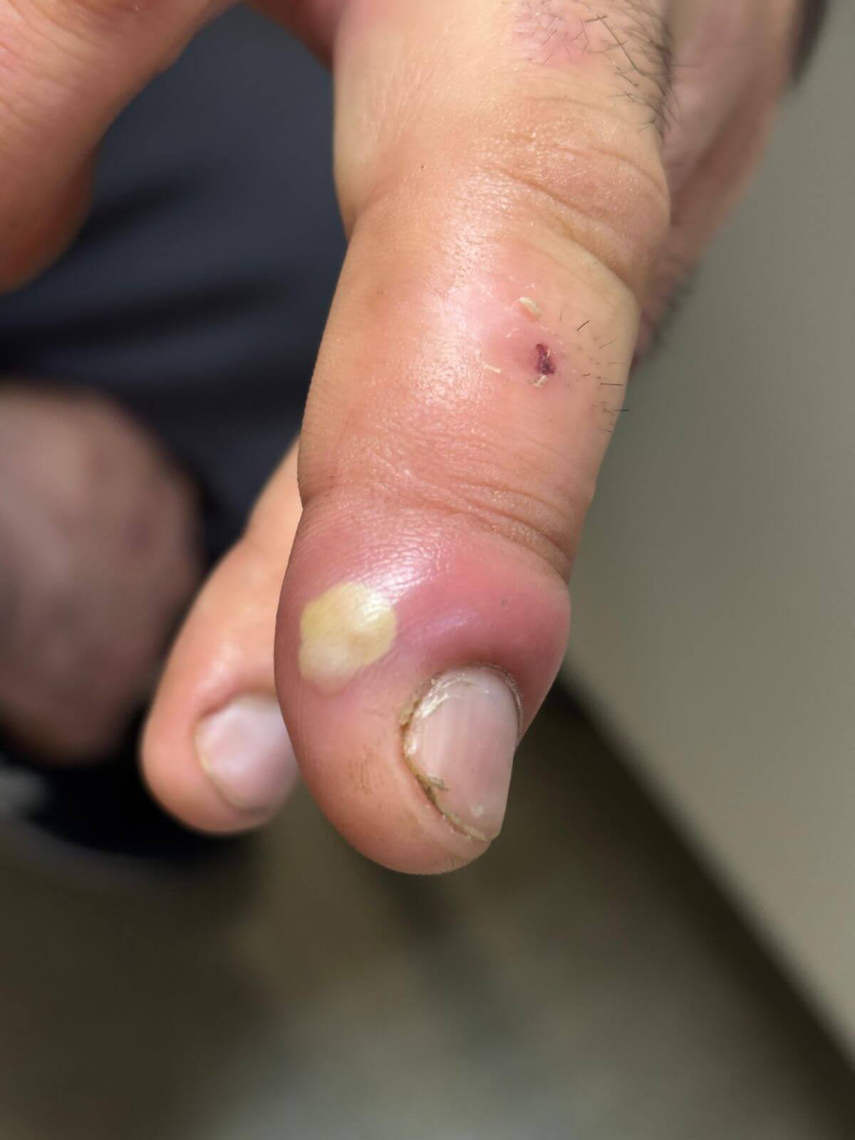 шанкр-панариций