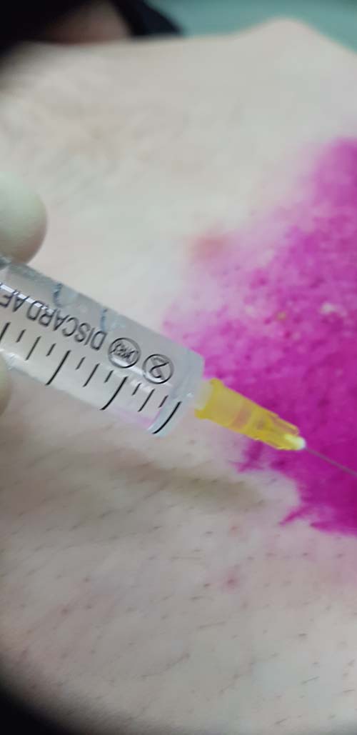 медикаментозное лечение лимфотропное введение антибиотиков