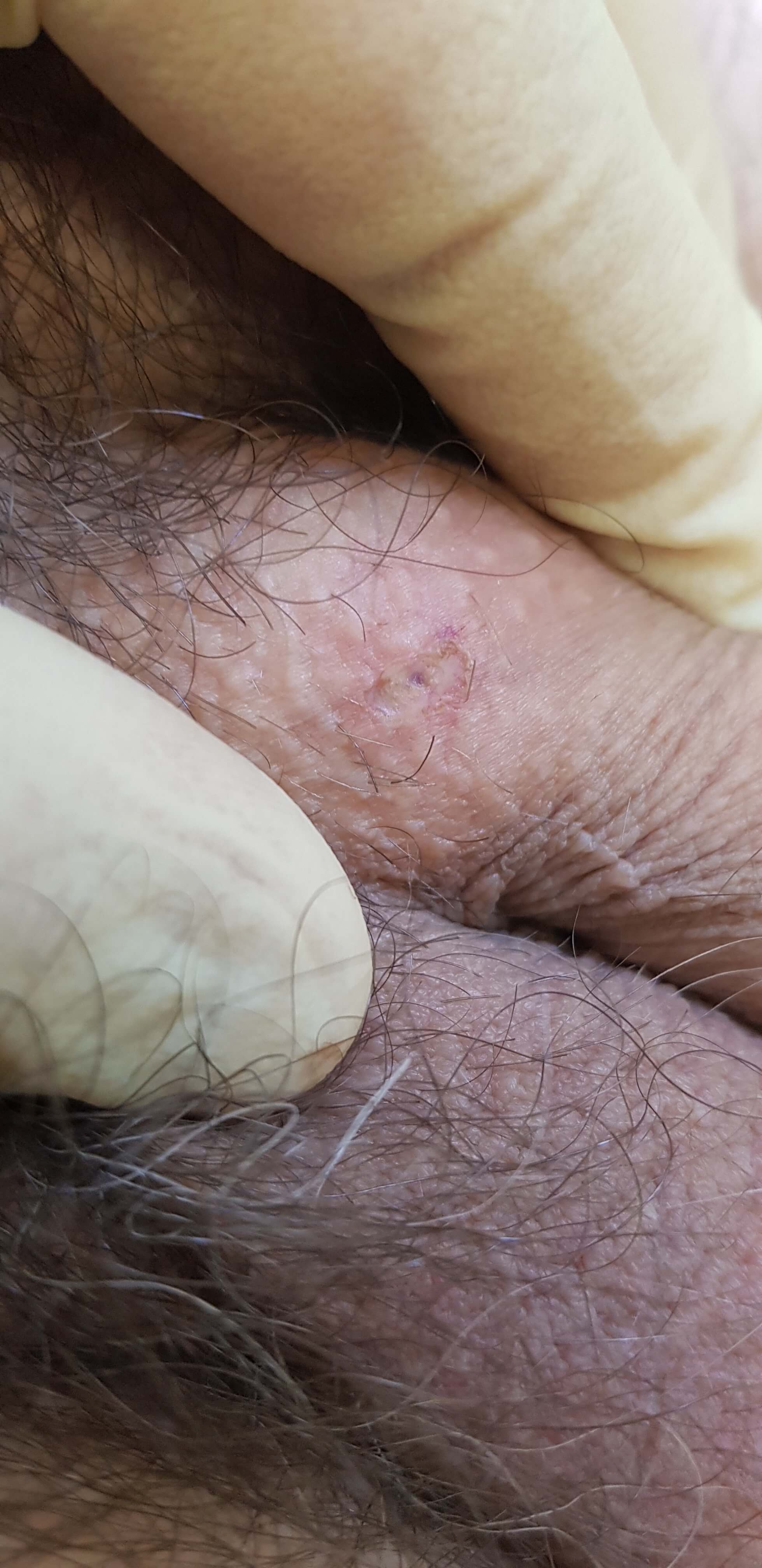 удаление кондилом радионожом радионож сургитрон