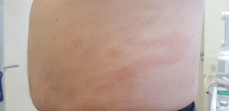 парапсориаз болезнь Брока