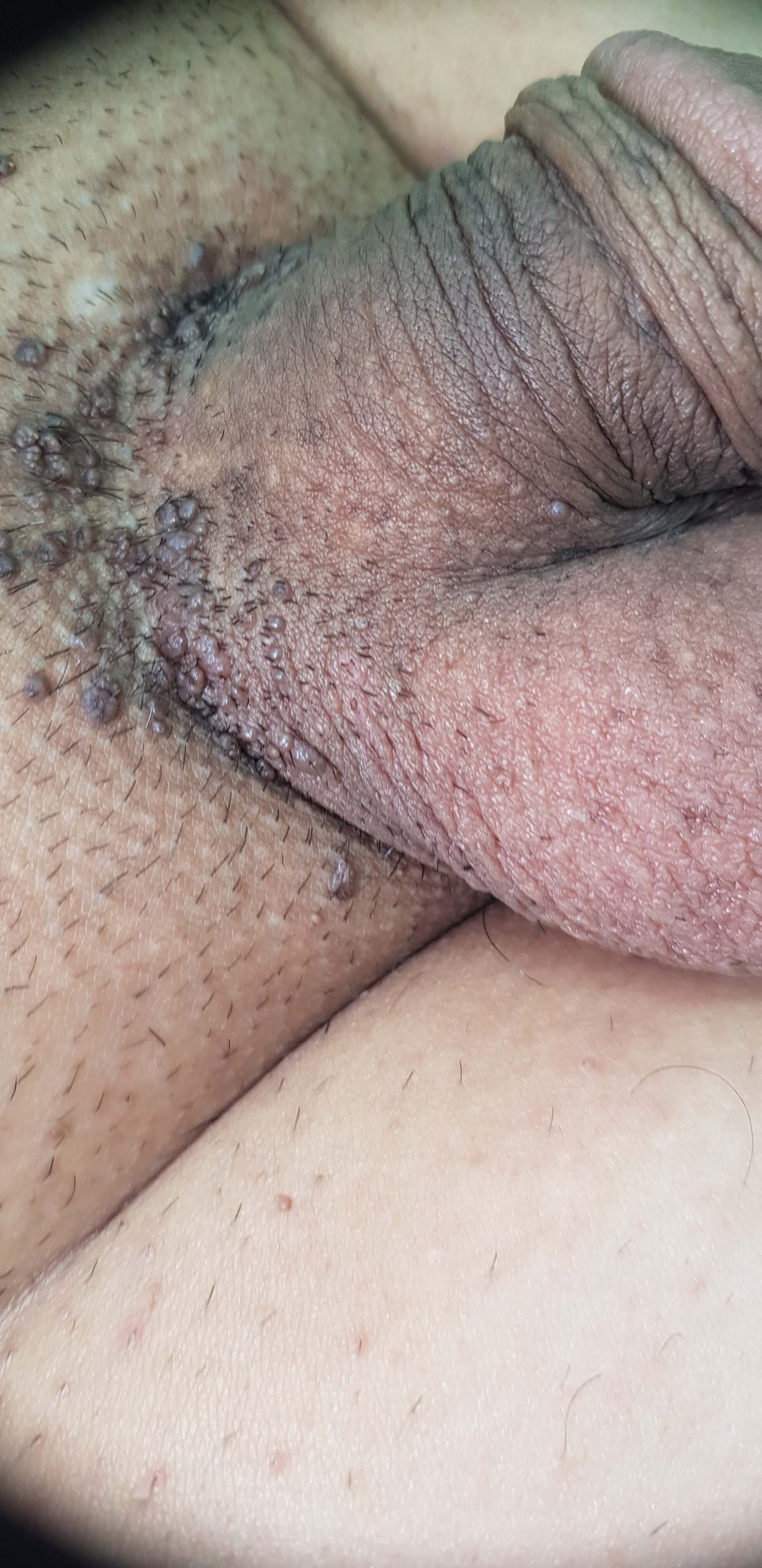 заражение папилломавирусом папилломавирус