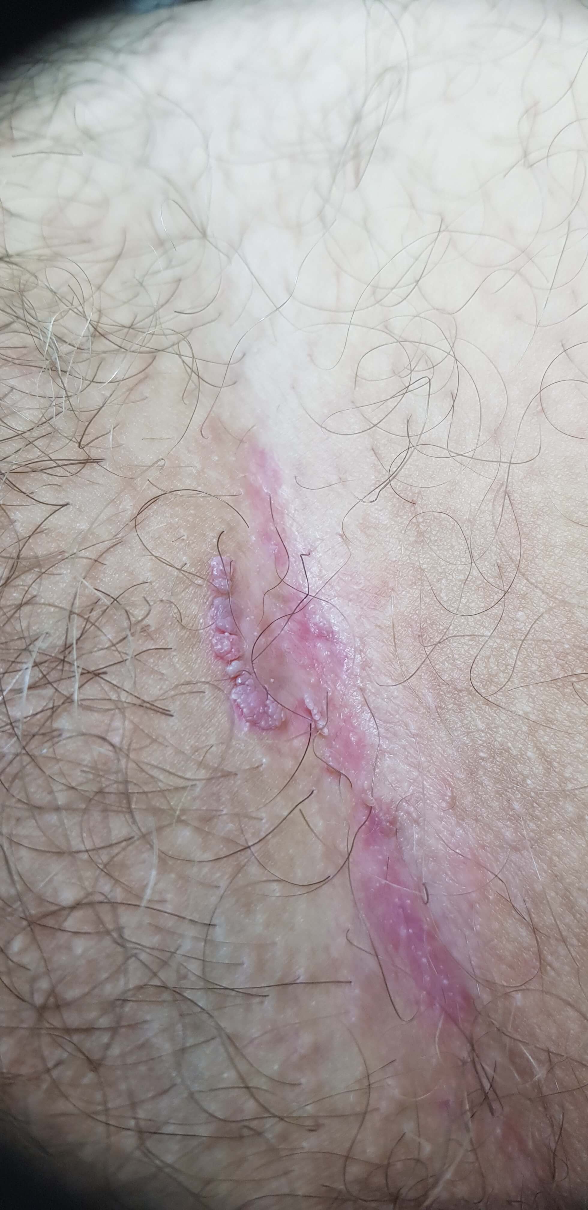 остроконечные кондиломы в паховых складках остроконечные кондиломы