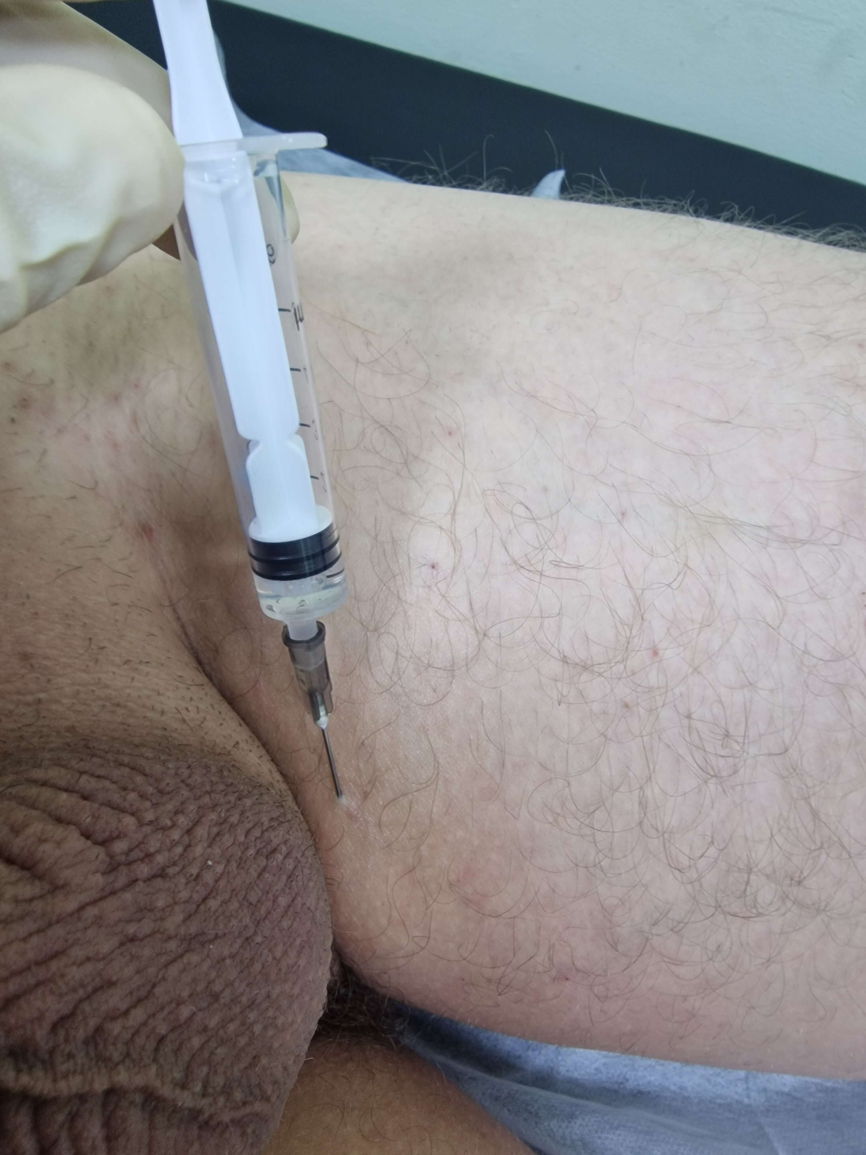 лимфотропное введение препаратов