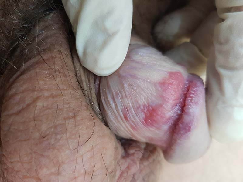 волдыри крапивницы