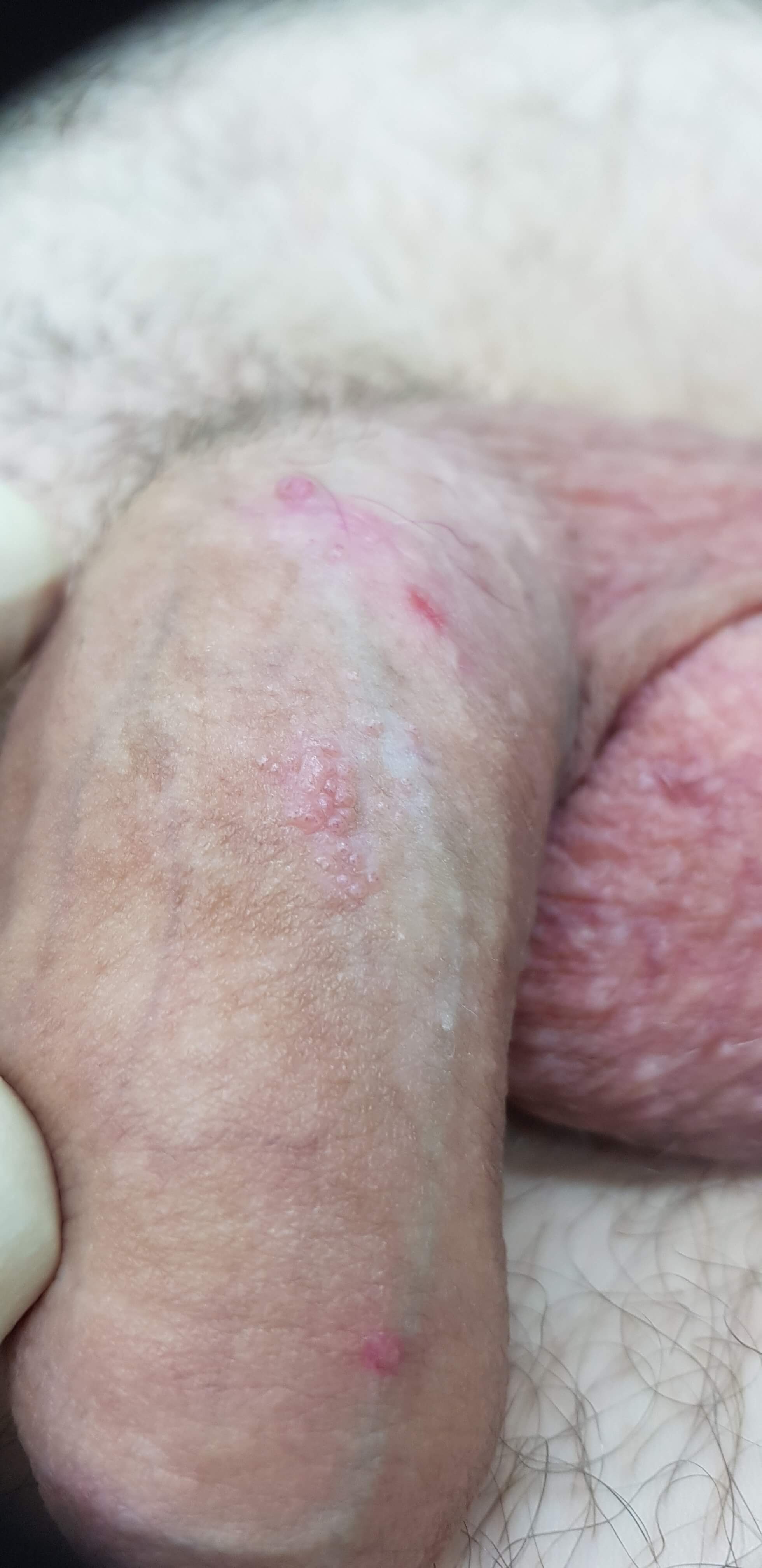 новообразования на члене кондиломы на члене