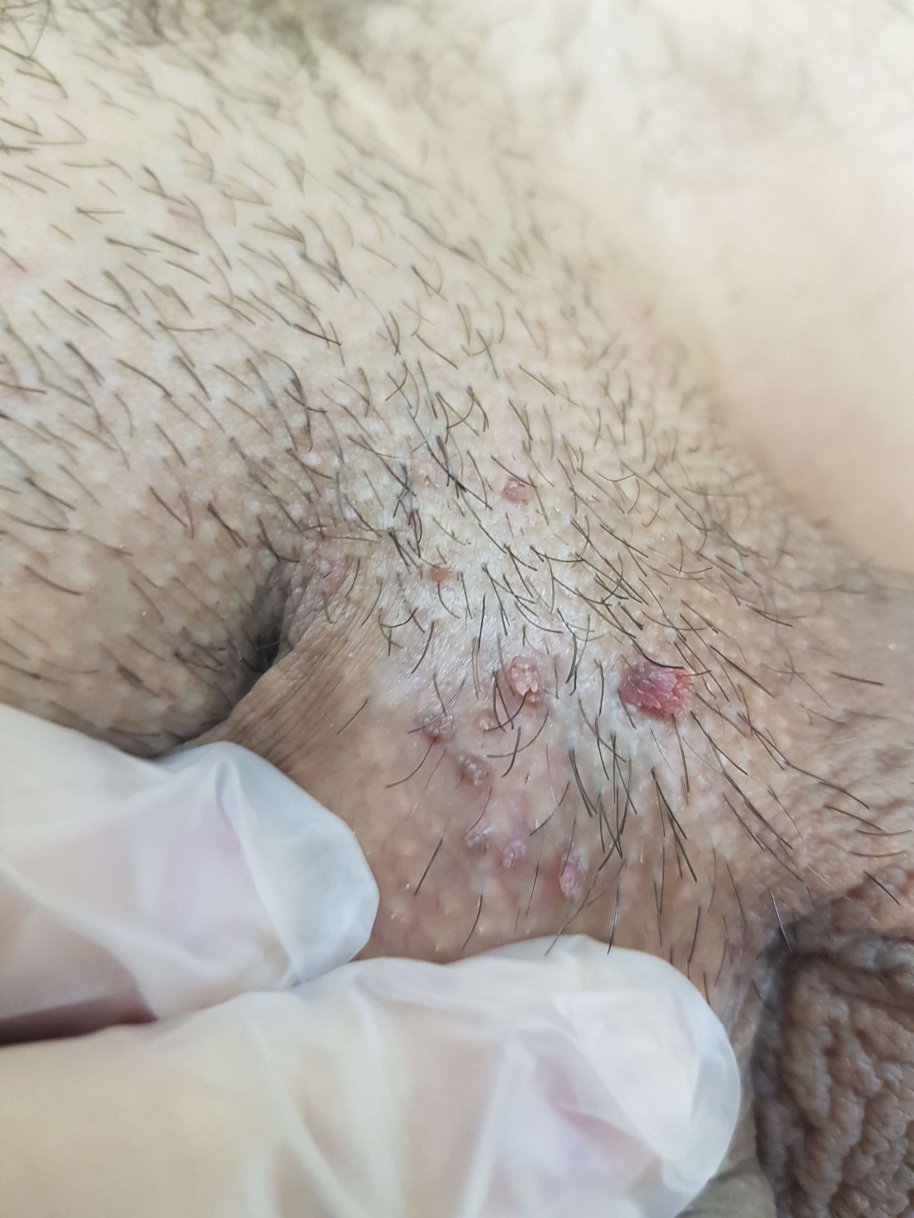 кондиломатозные элементы кондиломы мясного цвета