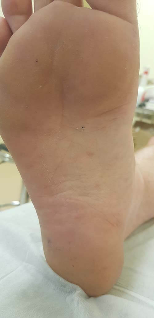 высыпания при сифилисе себорея при сифилисе