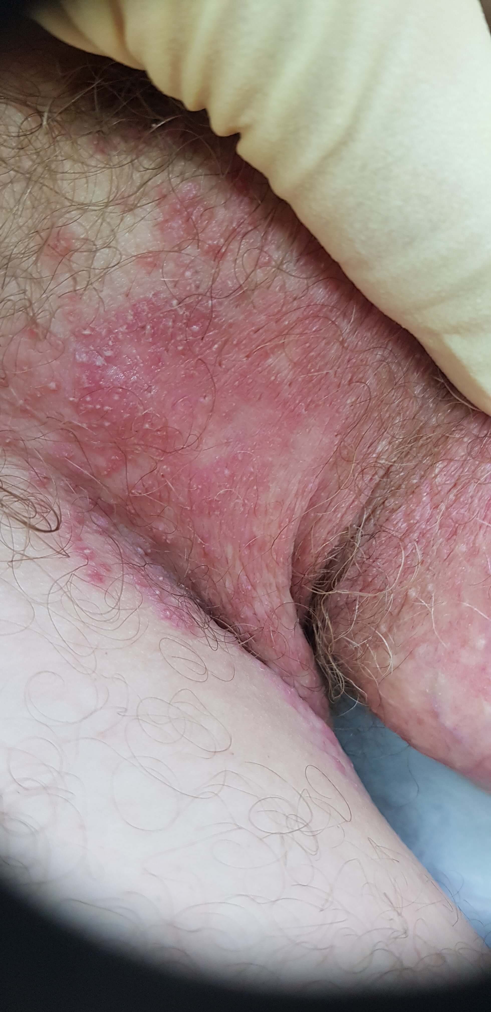 эрозия в паху глубокая эрозия в паховых складках