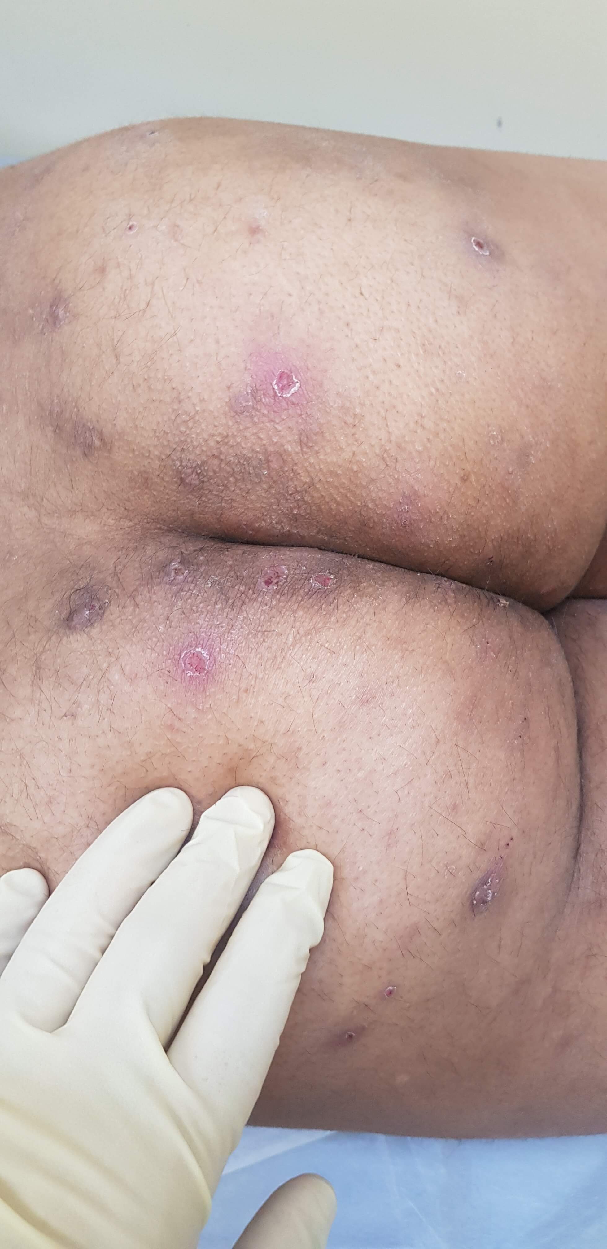 чесотка с осложнениями