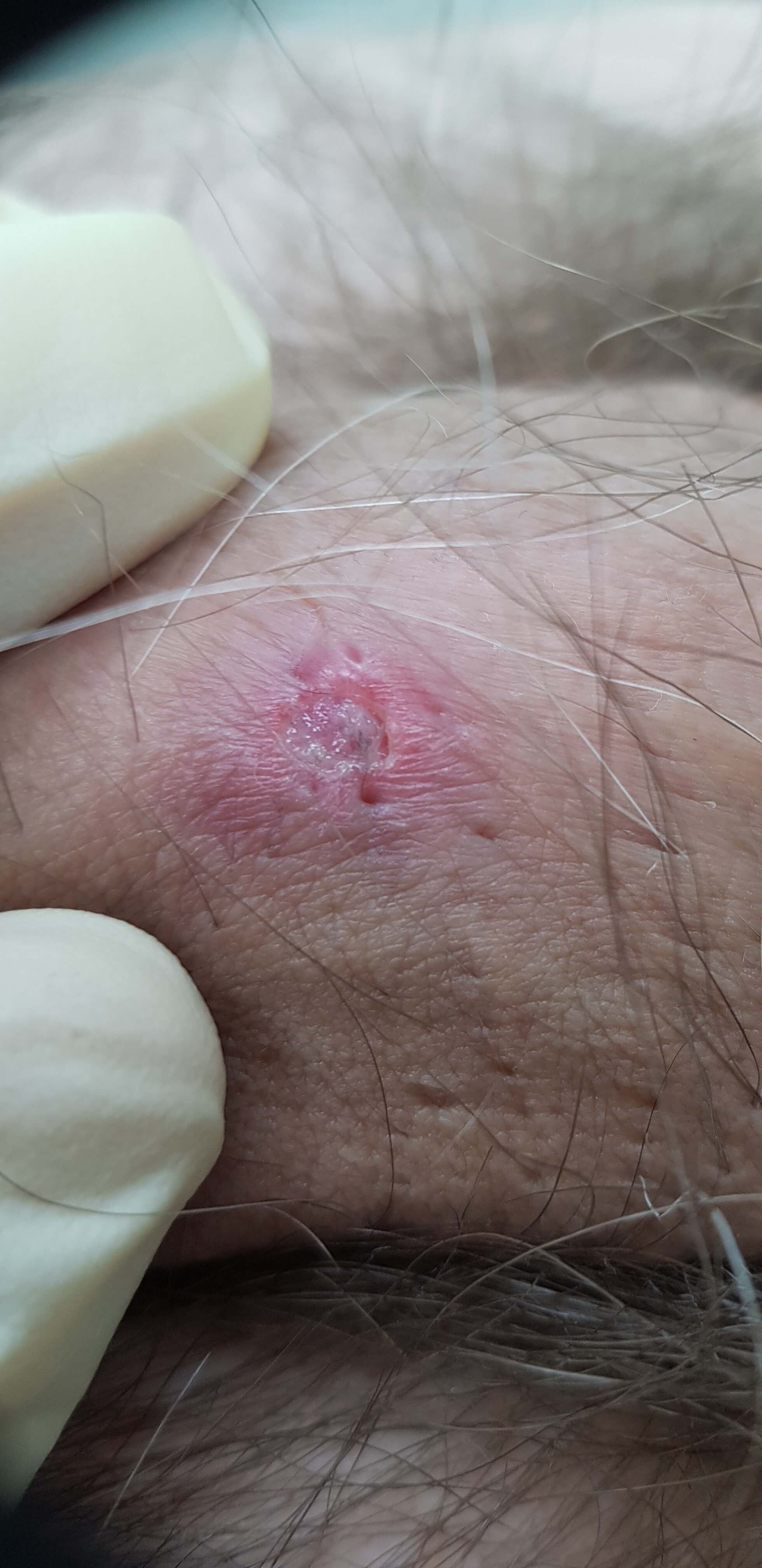 Твердый шанкр при первичном сифилисе