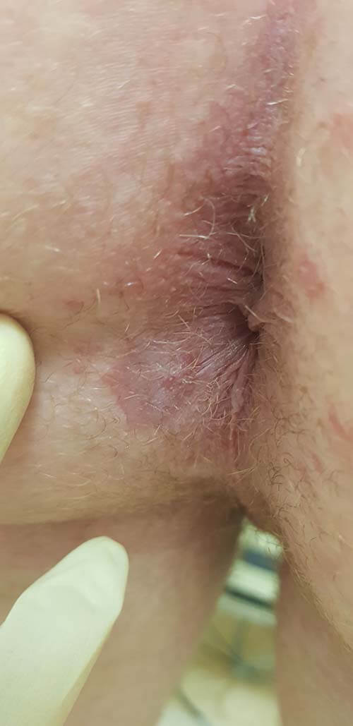 вегетирующие папулы широкие кондиломы при сифилисе