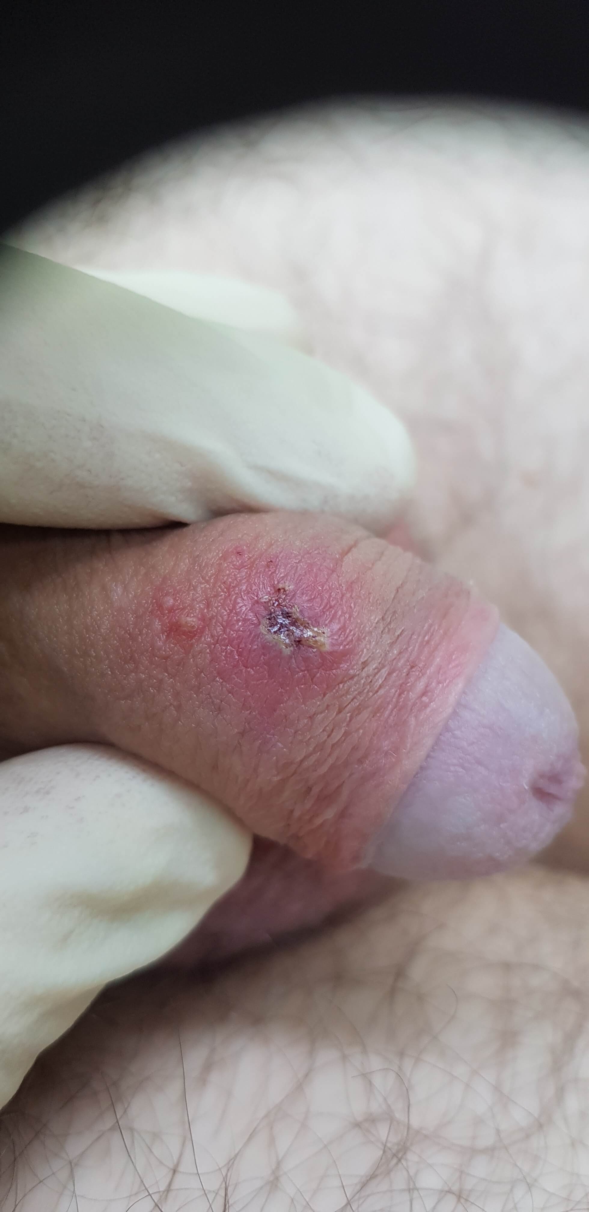 герпес 2 типа