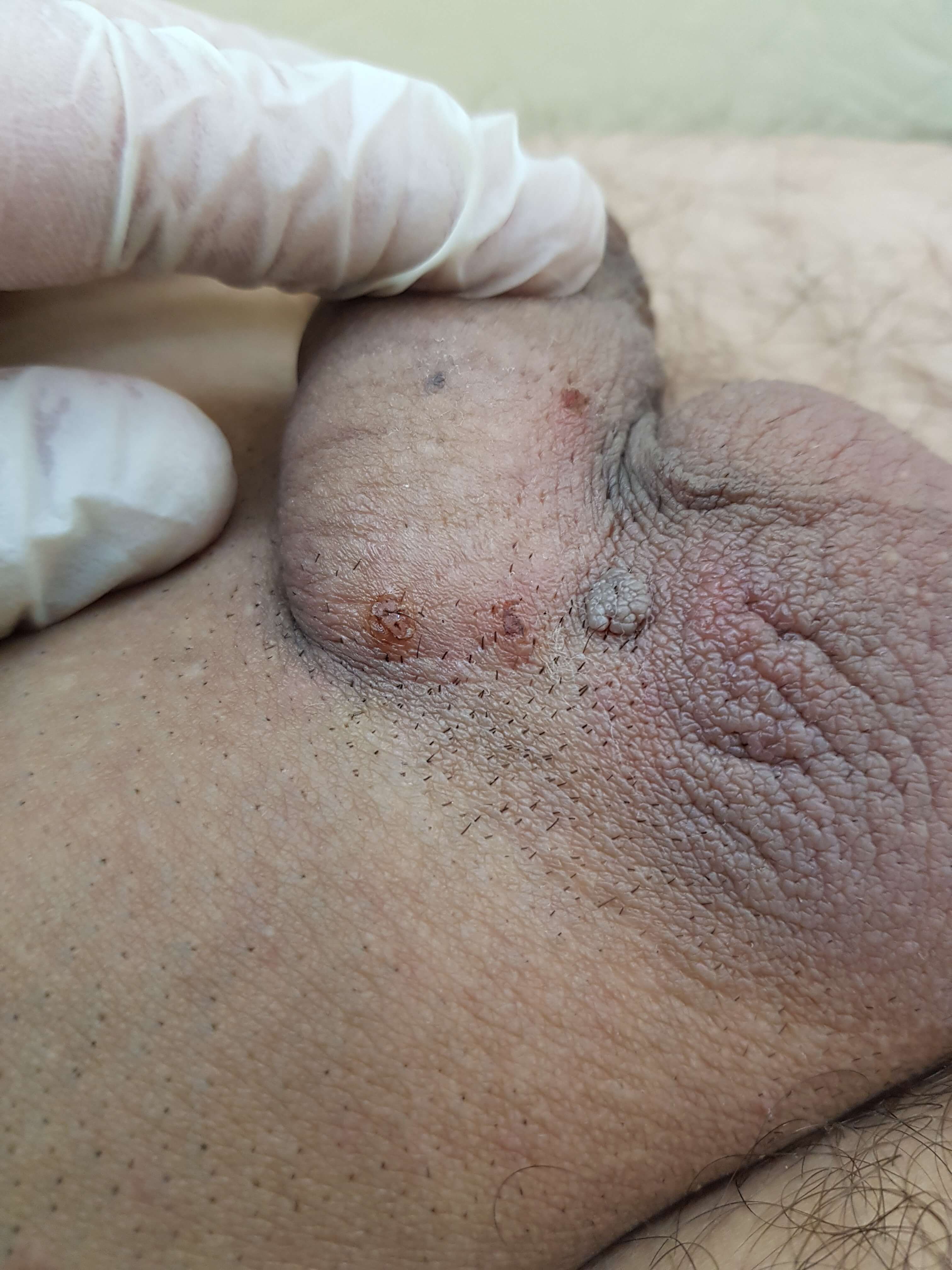 безопасное удаление кондилом удаление кондилом сургитоном