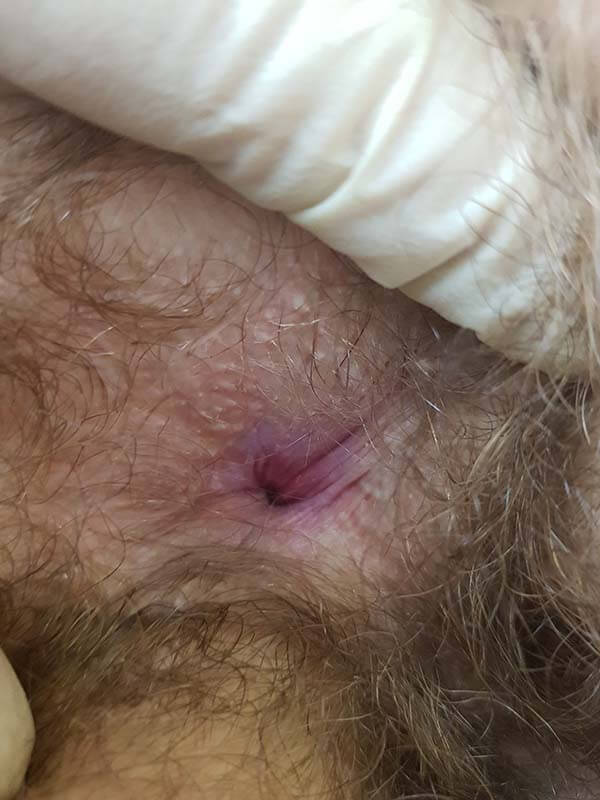 интратон электромиостимулятор