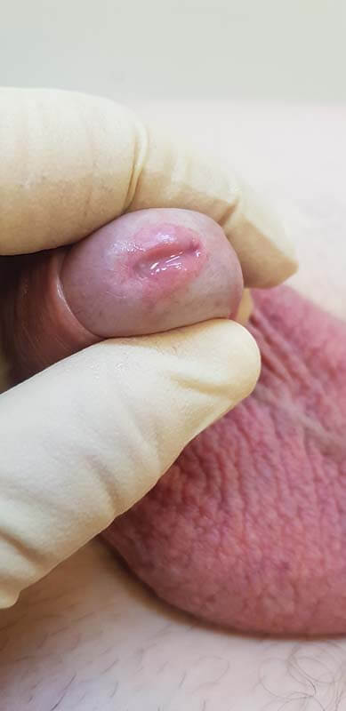 симптомы уреаплазмоза