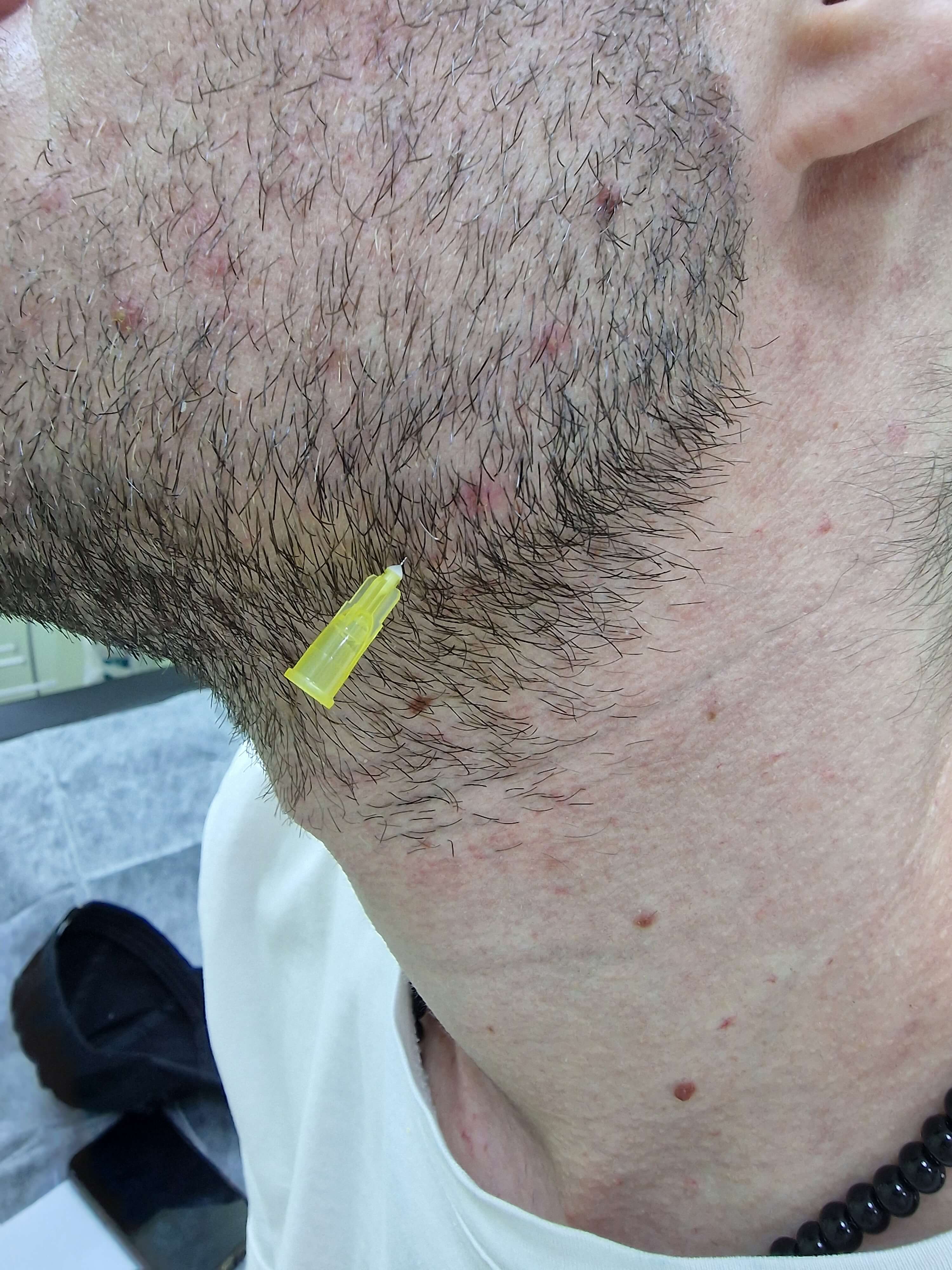 лимфотропка