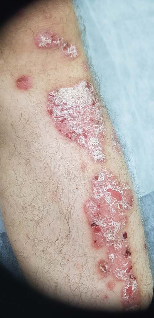 форма псориаза распространенный псориаз