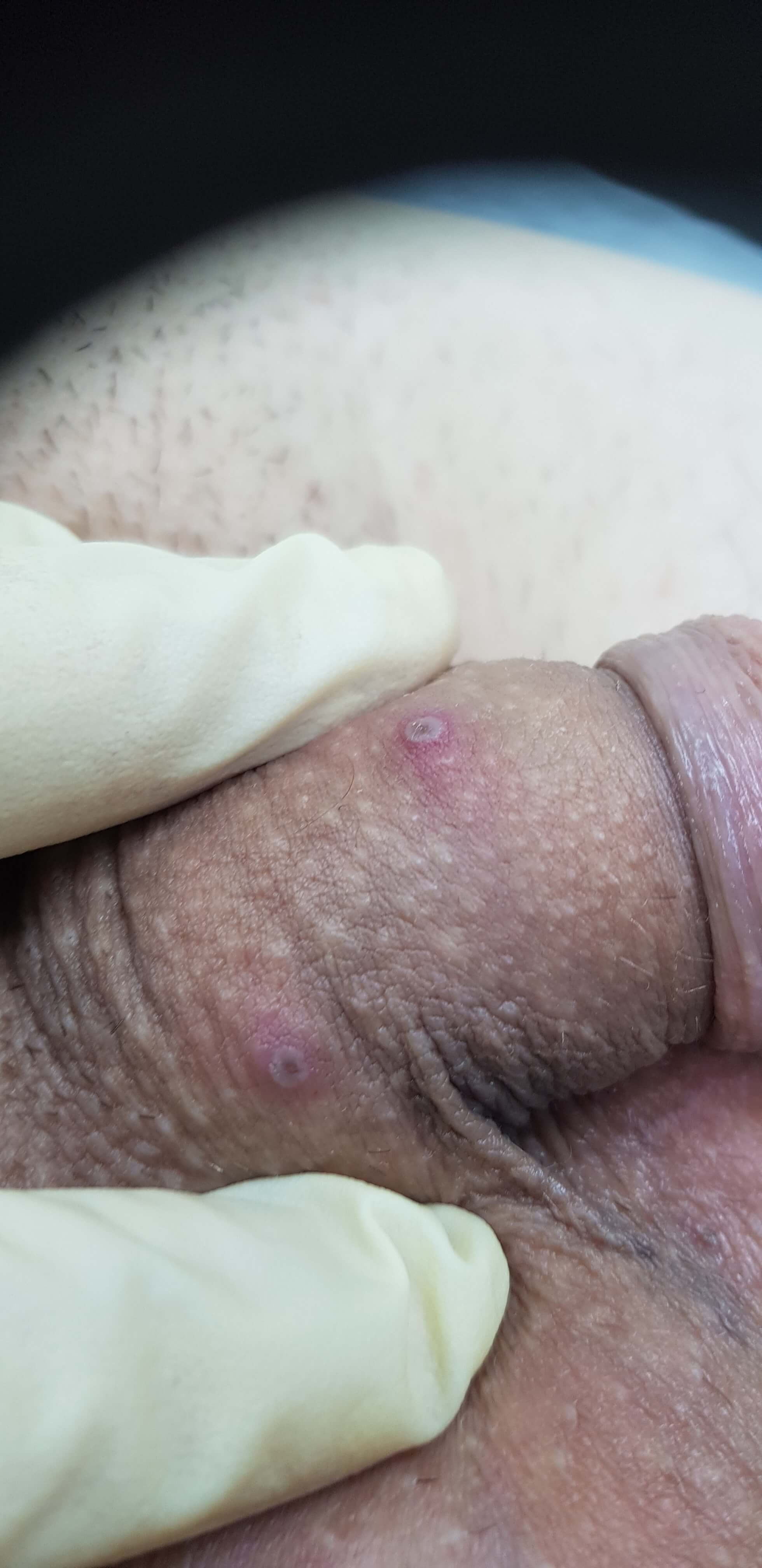 везикулы при герпесе