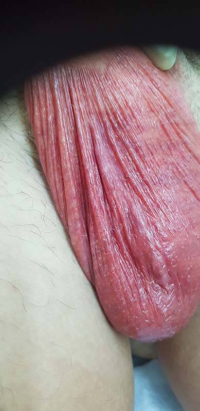 боли в мошонке при орхите