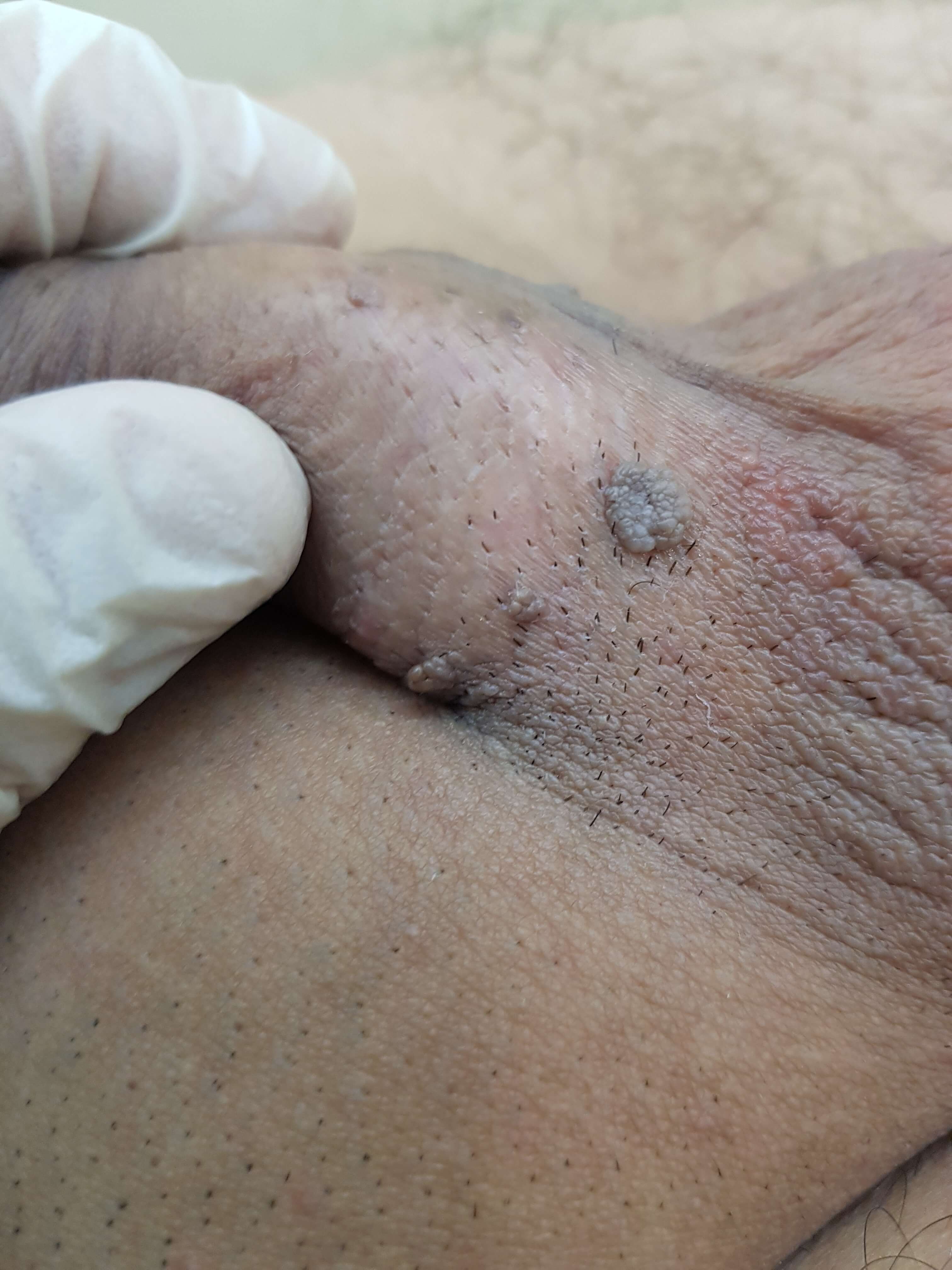 кондиломы на основании члена удаление новообразований сургитоном