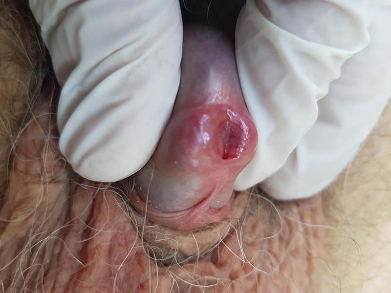 признаки микоплазмы и уреаплазмы