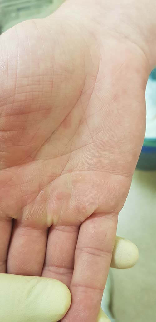 симптомы сифилиса сыпь на ладонях при сифилисе