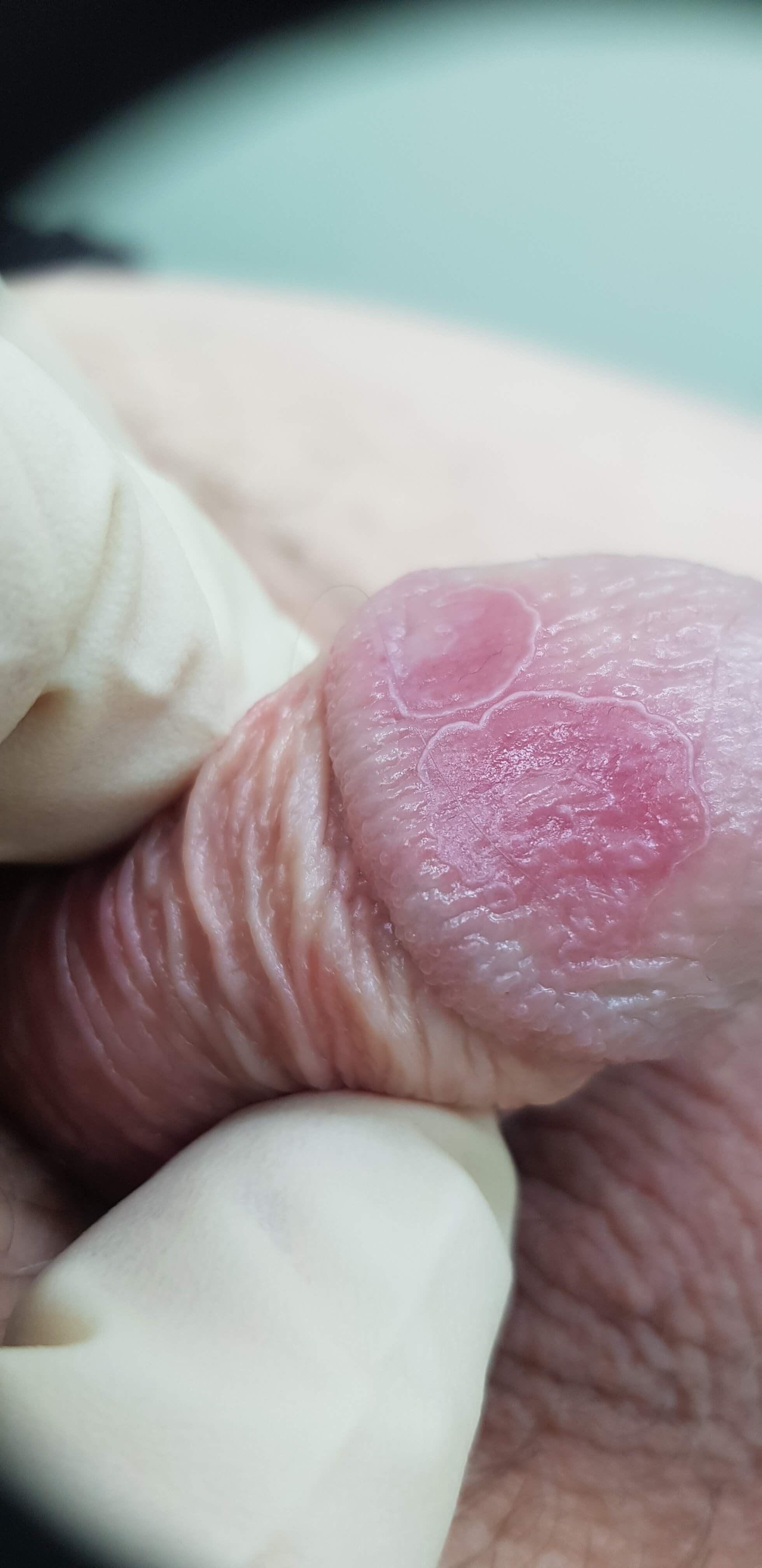 половой псориаз