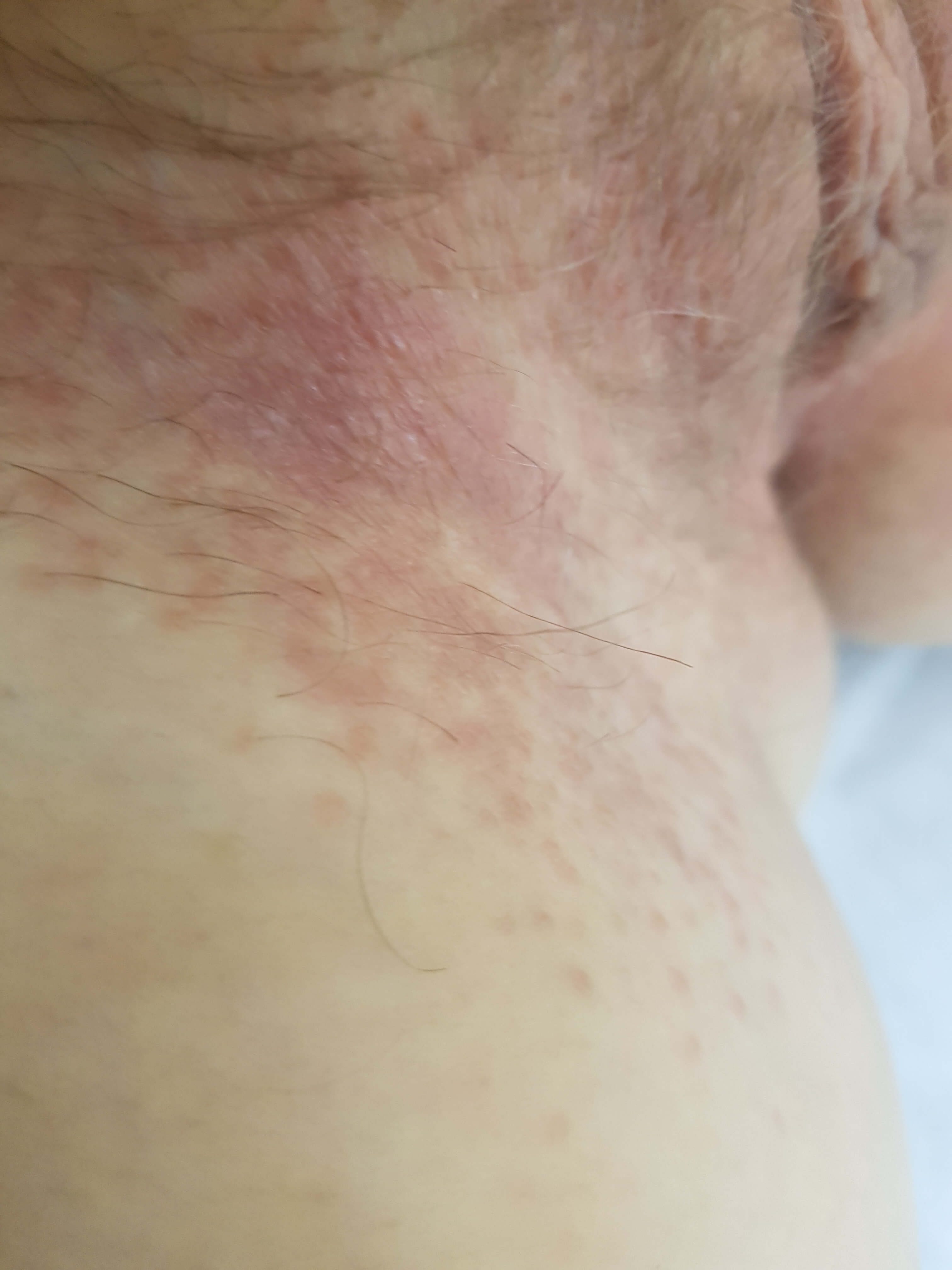 зуд в паху опрелости у женщин