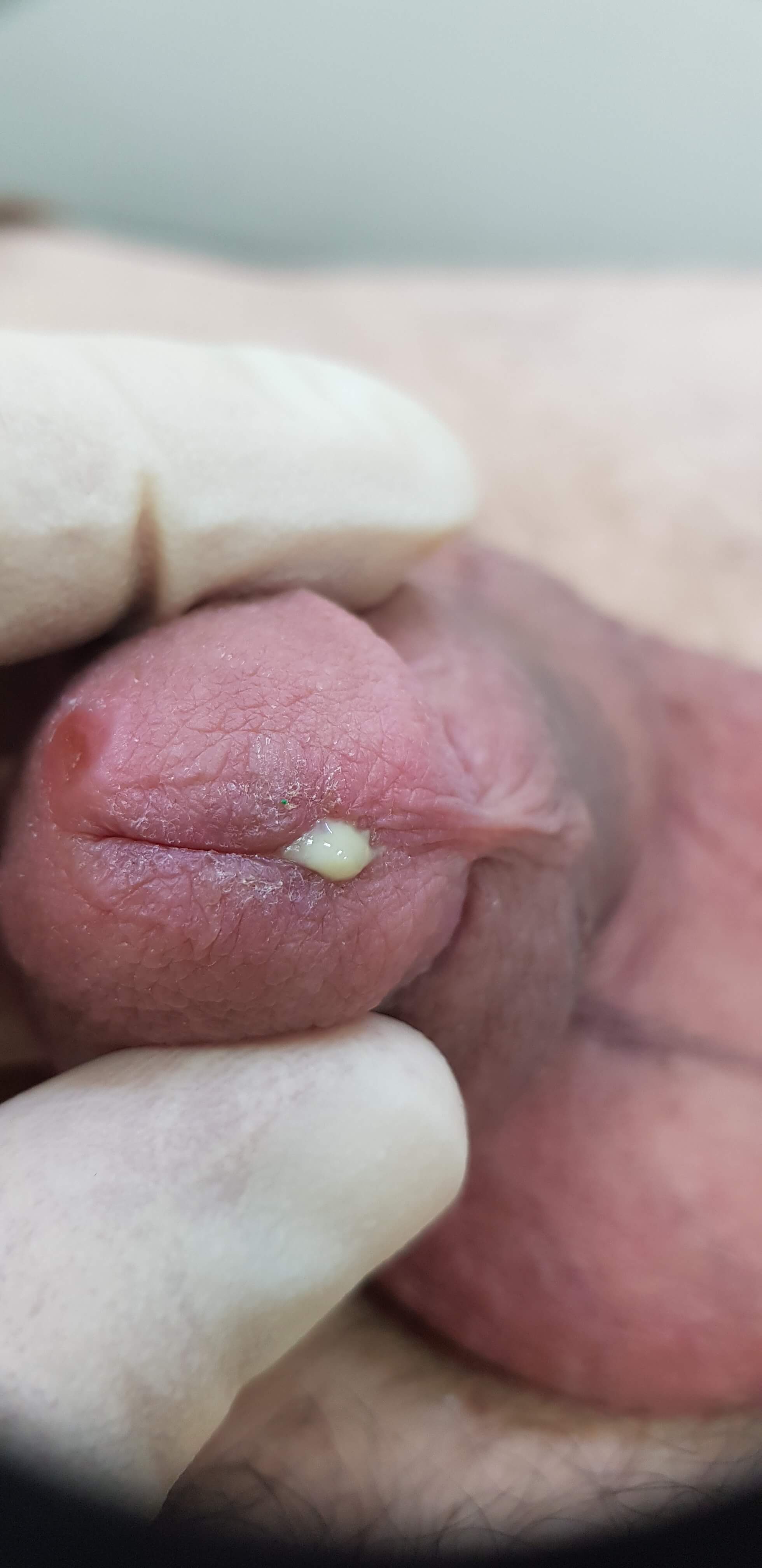 Заразиться гонореей можно через поцелуй