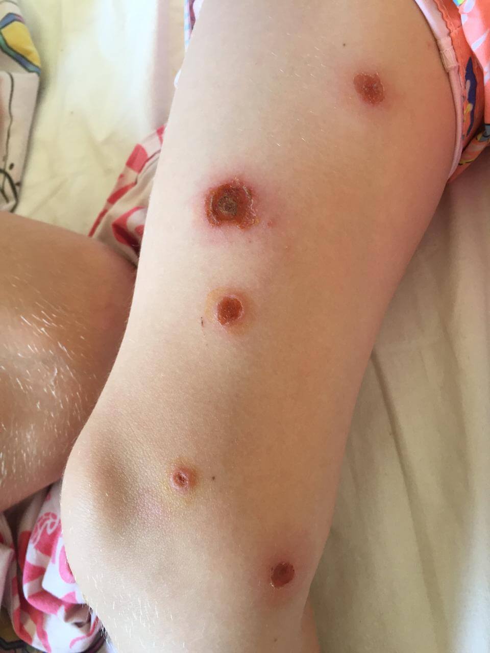 герпетические везикулы