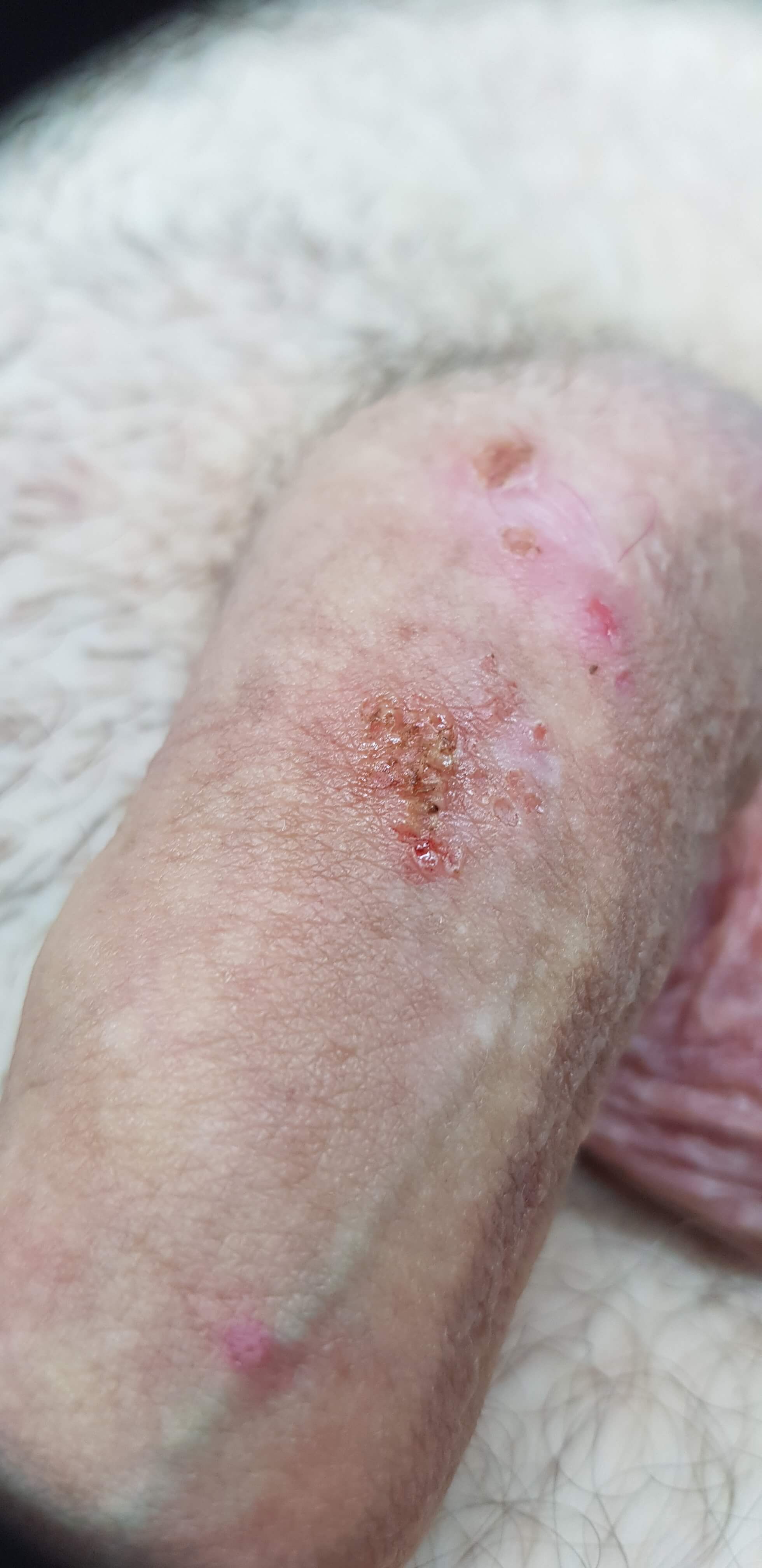 взятие образцов тканей для гистологического исследования удаление кондилом