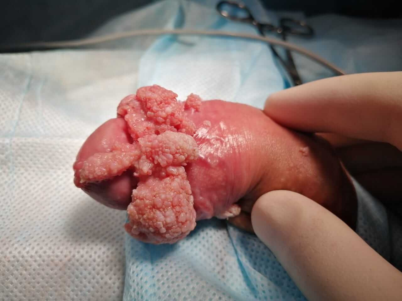 конгломераты кондилом