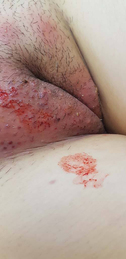 милиарный сифилид Рapulosa milliaris