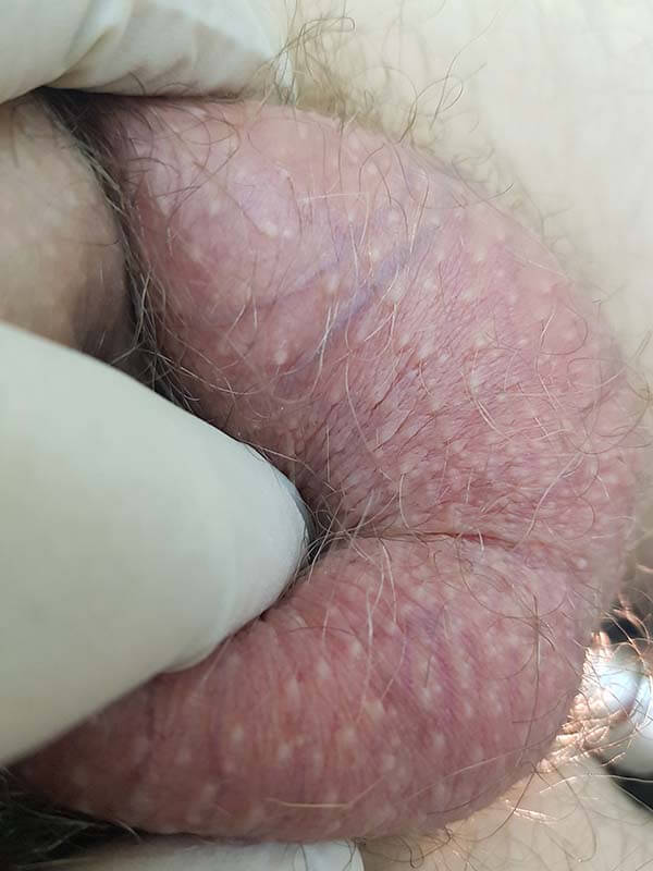 перекрут яичка патология яичек