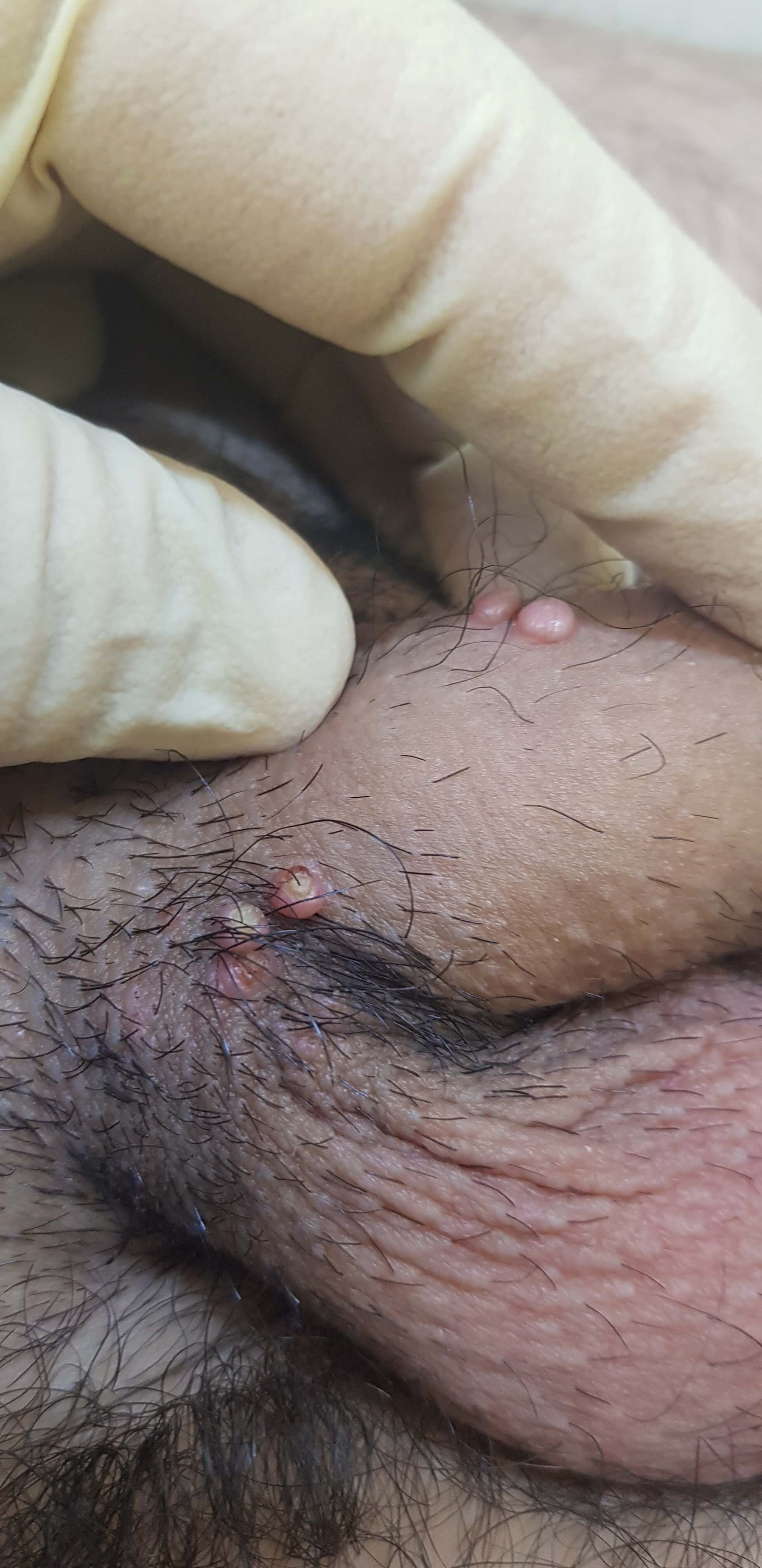 папулы моллюска