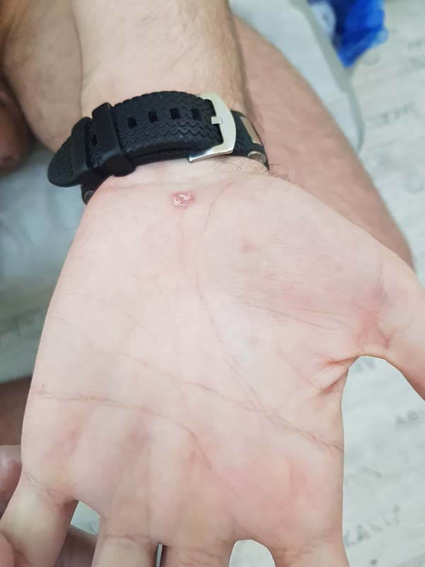 себорейные высыпания себорейные папулы при сифилисе