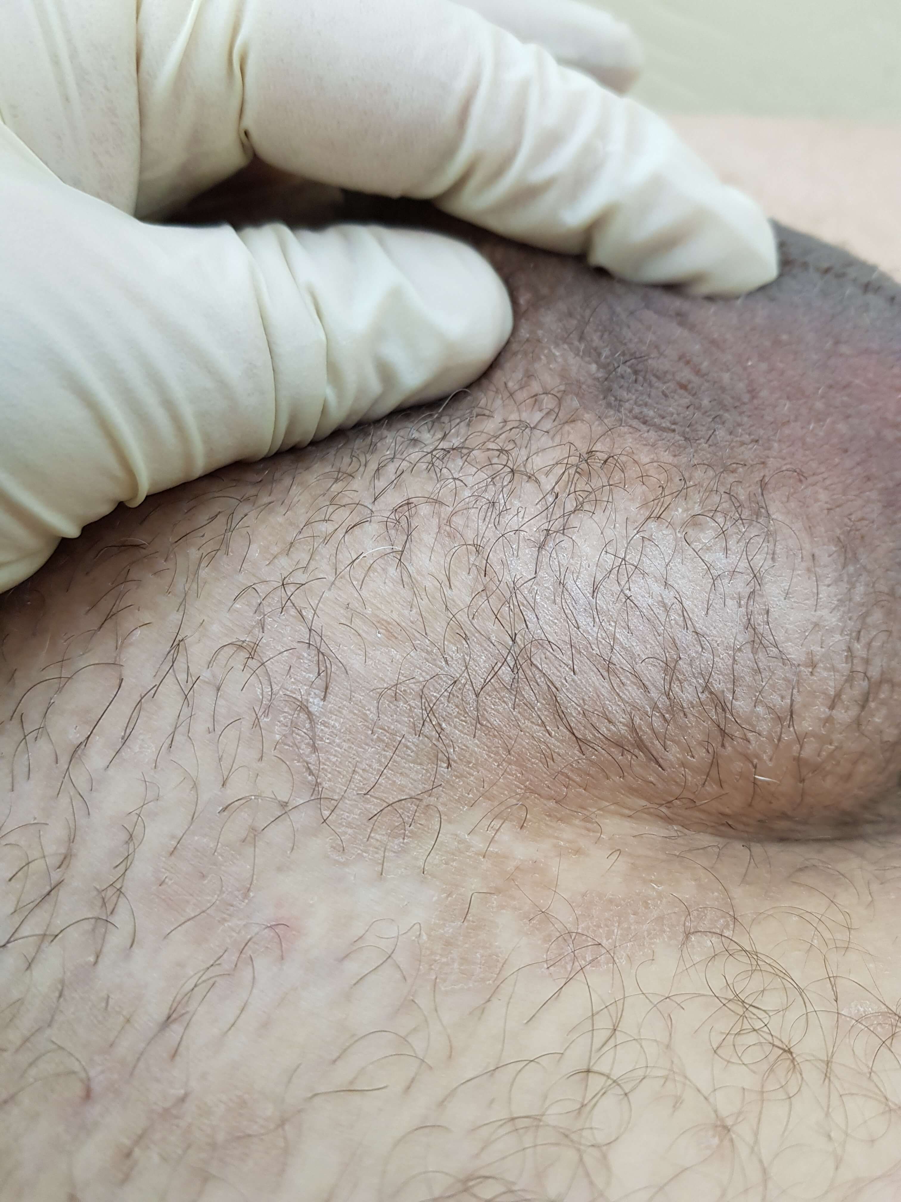 Отрубевидный лишай