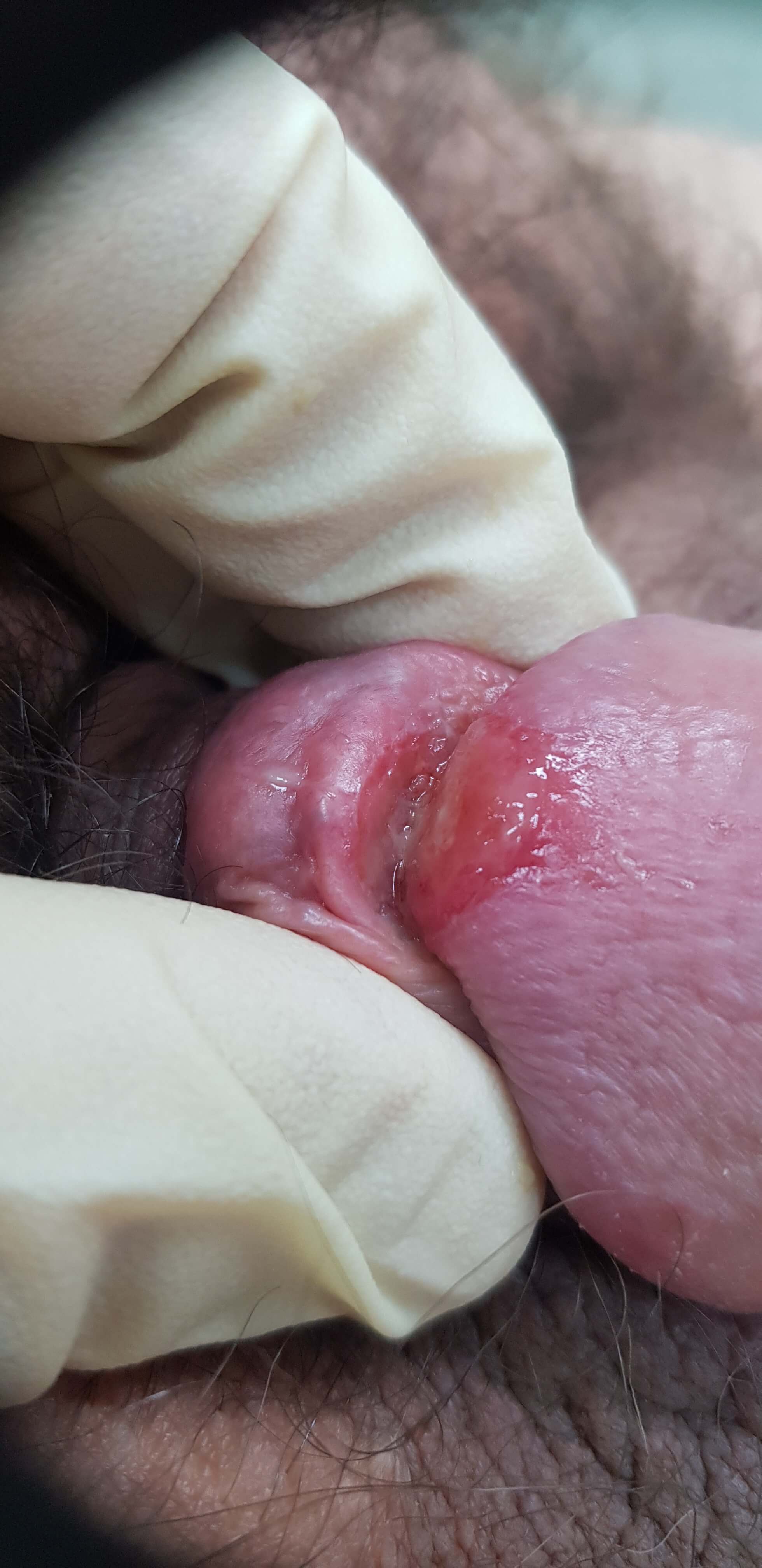 Болячка на головке члена