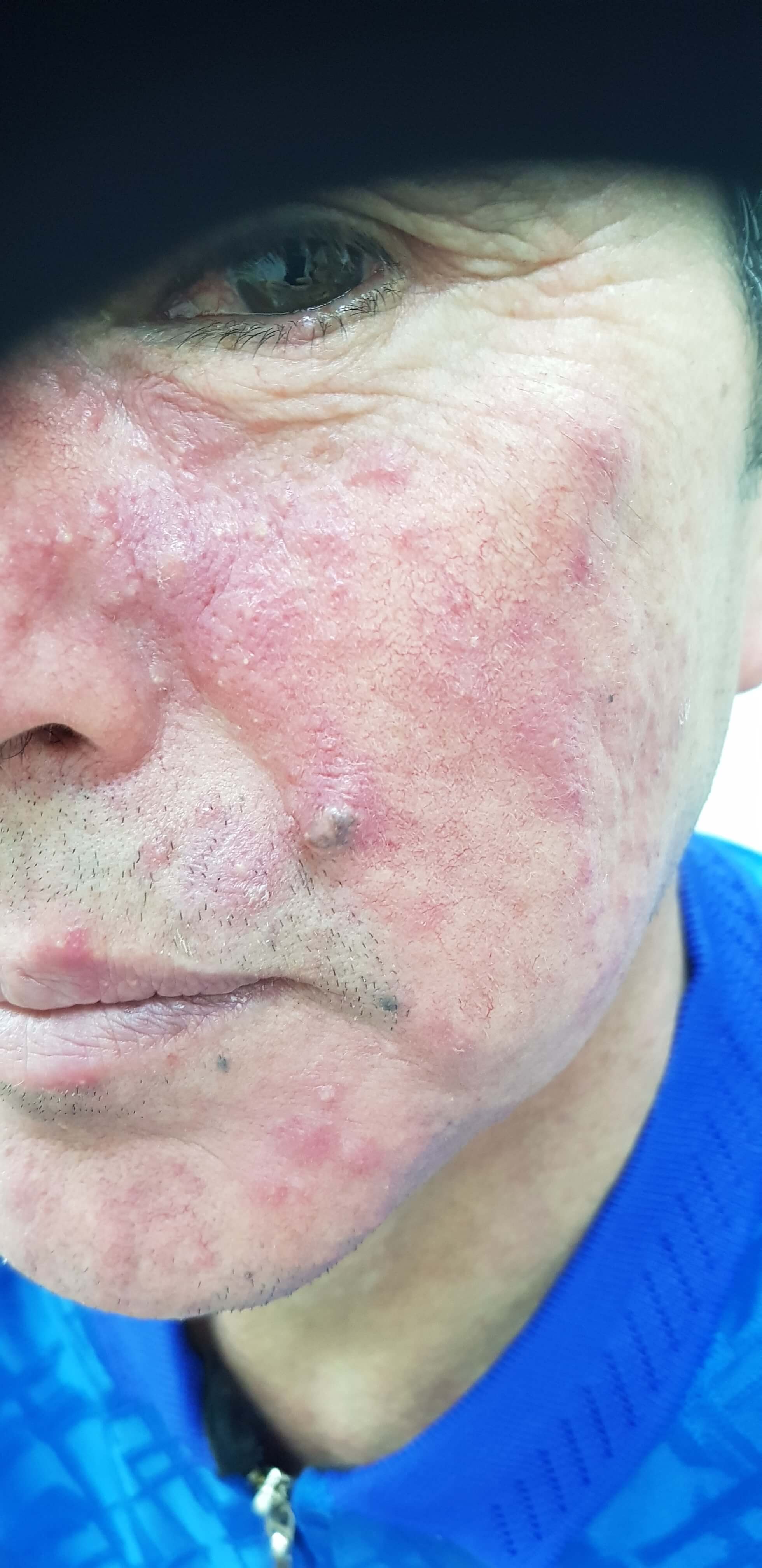 розовые высыпания