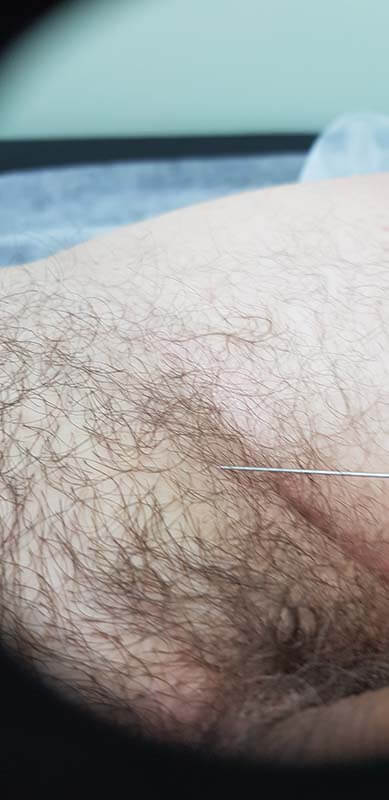 лимфотропное введение антибиотиков и ферментов лимфотропное введение антибиотиков и ферментов